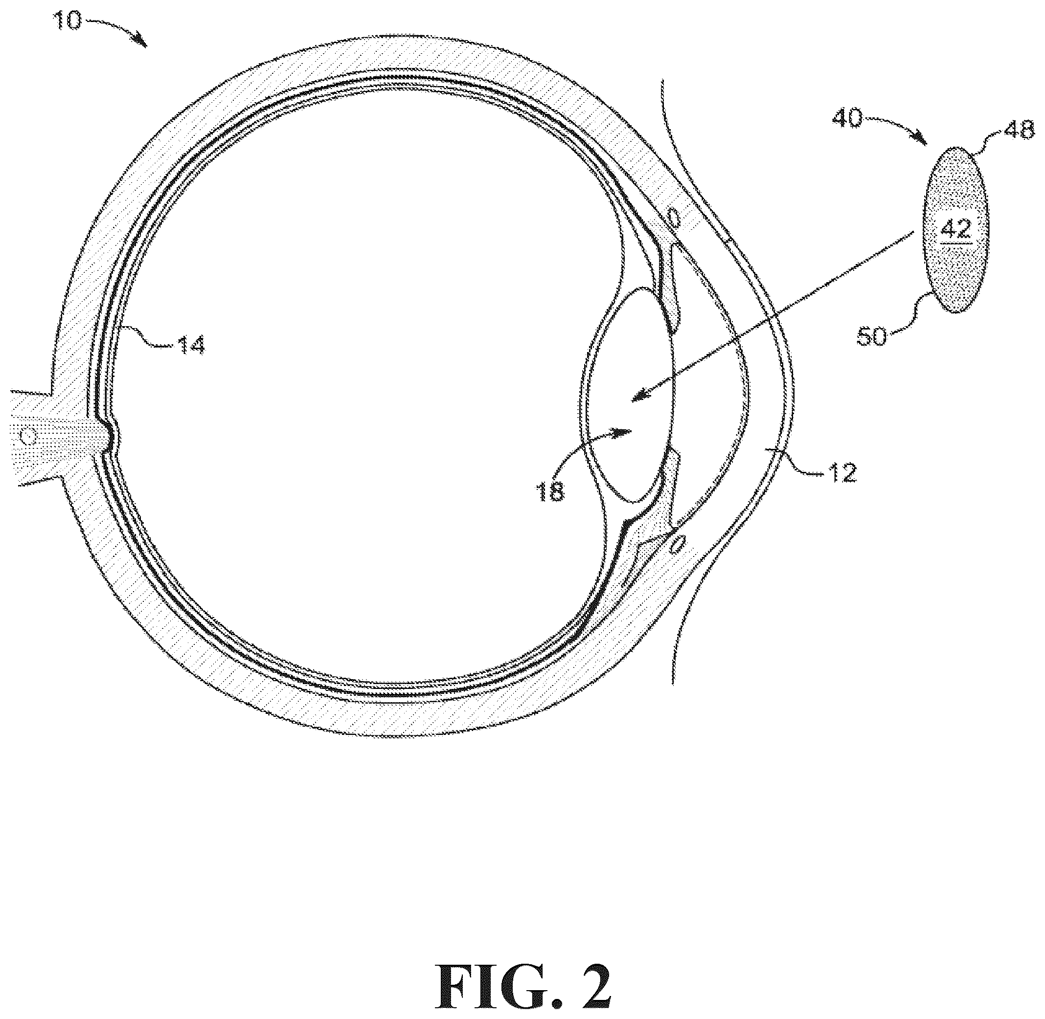 Patent US12318331 Figure 2 – Intraocular lens docking station