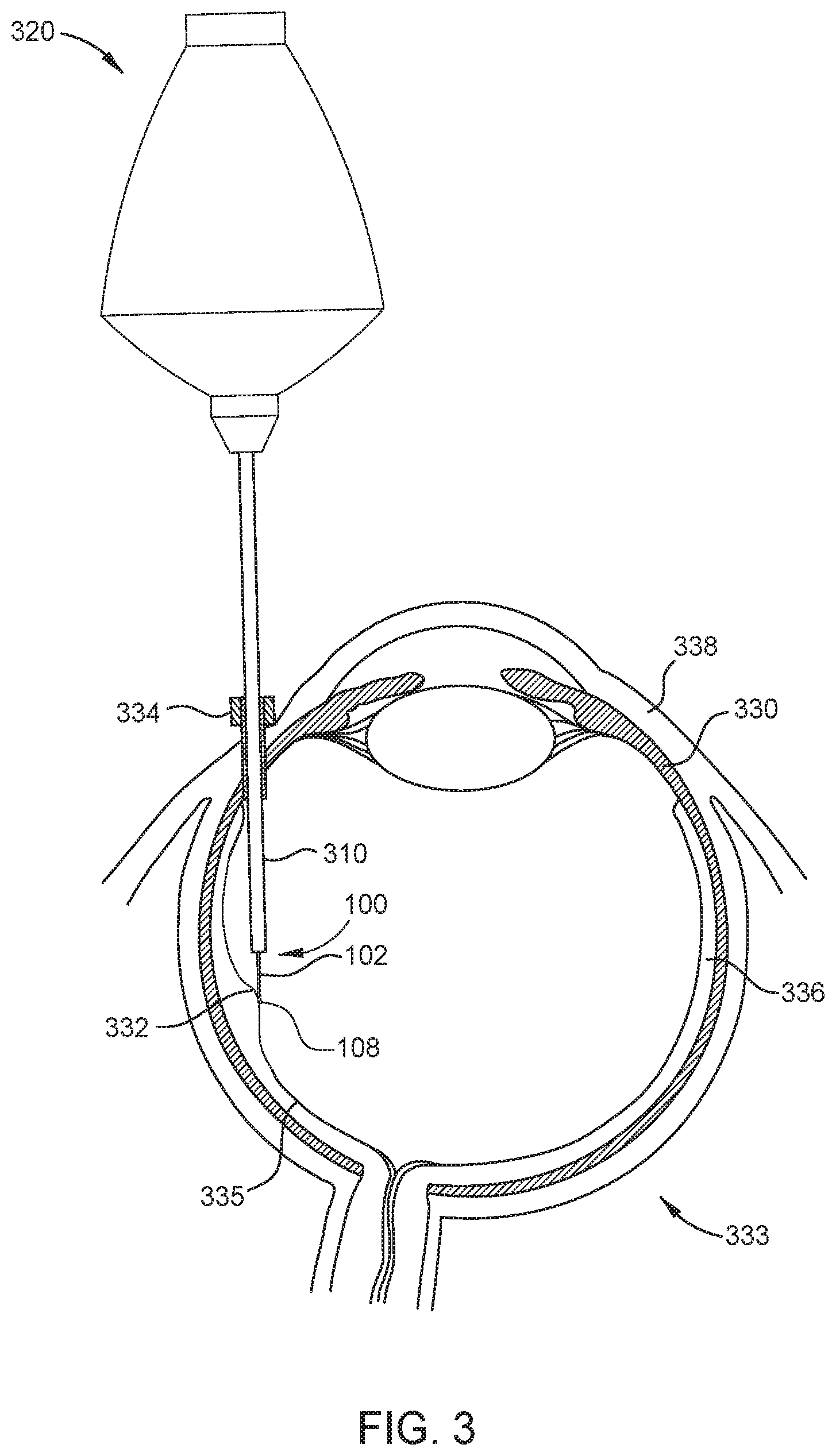 Patent US12318343 Figure 3 – Retina massage and smoothing device