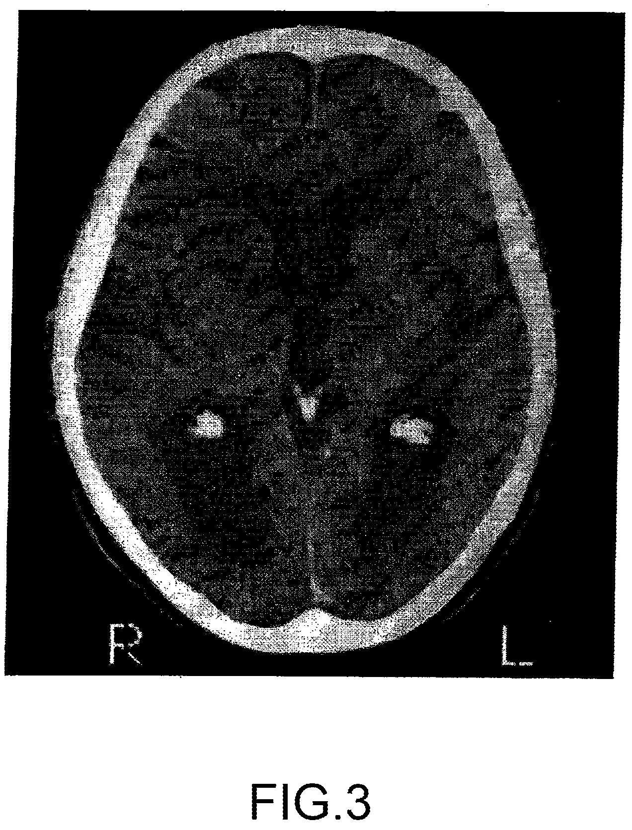 Patent US12318377 Figure 3 – Method and system for reducing the likelihood of a porphyromonas gingivalis infection in a human being