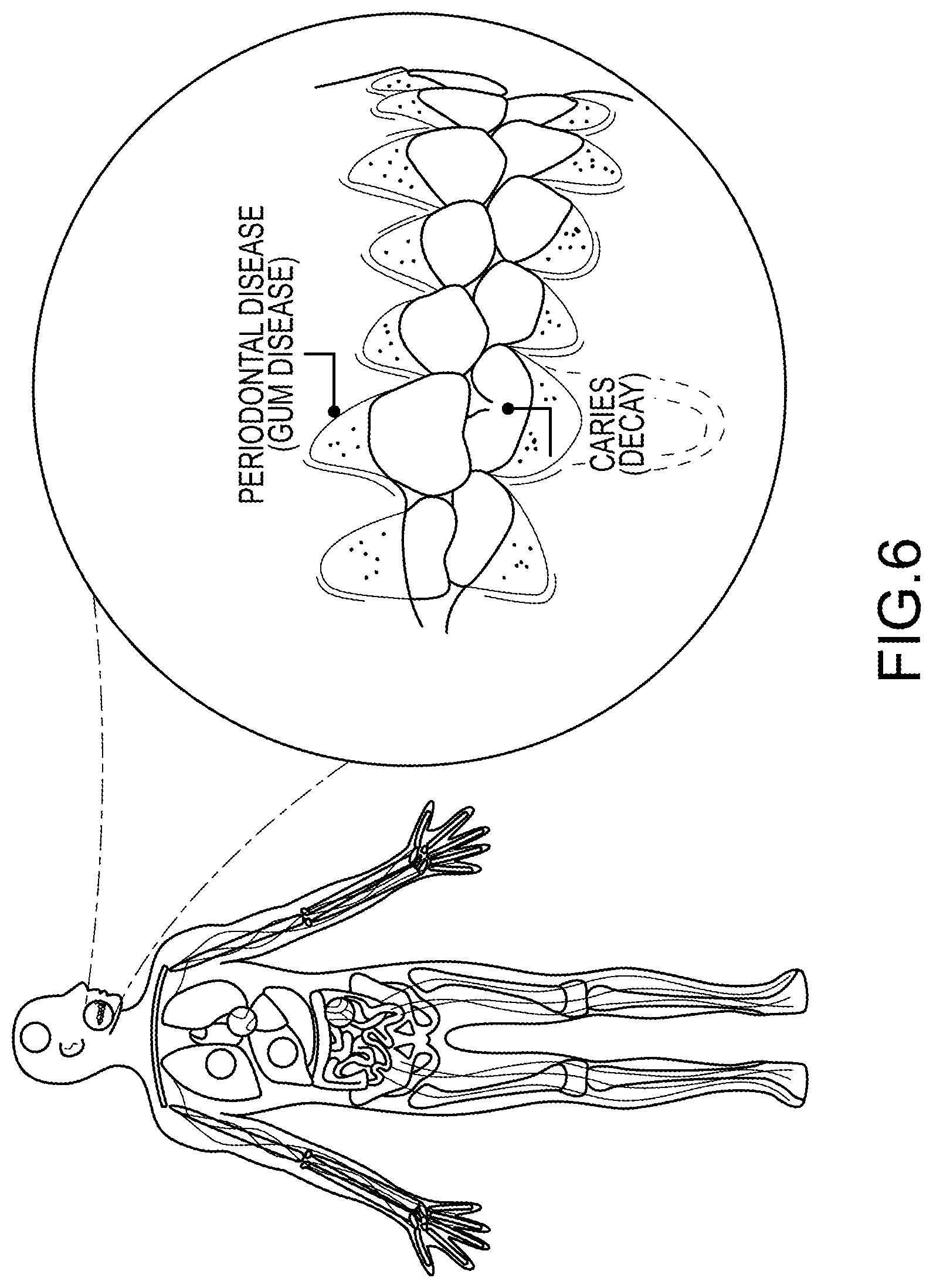 Patent US12318377 Figure 6 – Method and system for reducing the likelihood of a porphyromonas gingivalis infection in a human being