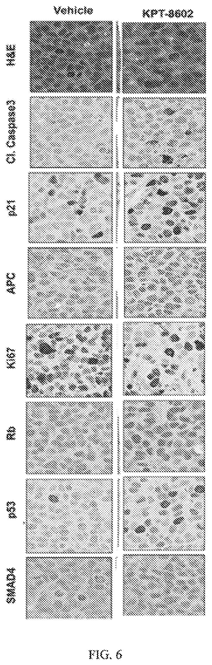 Patent US12318386 Figure 5 – Combination of XPO1 inhibitors and second agents for the treatment of prostate cancer
