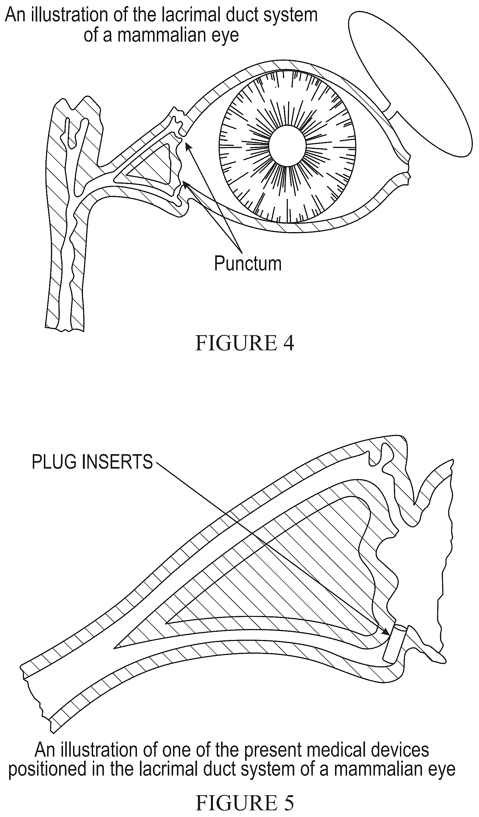 Patent US12318394 Figure 5 – Devices and methods for delivering a bio-active agent or bio-active agents