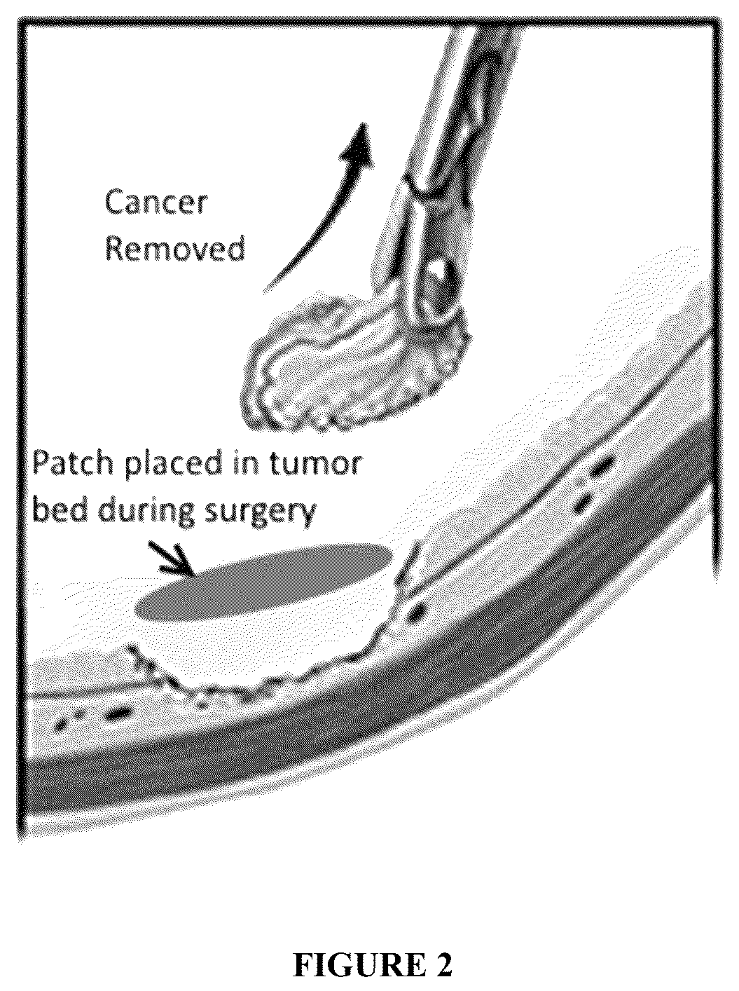 Patent US12318491 Figure 2 – Intraoperative topically-applied non-implantable rapid release patch