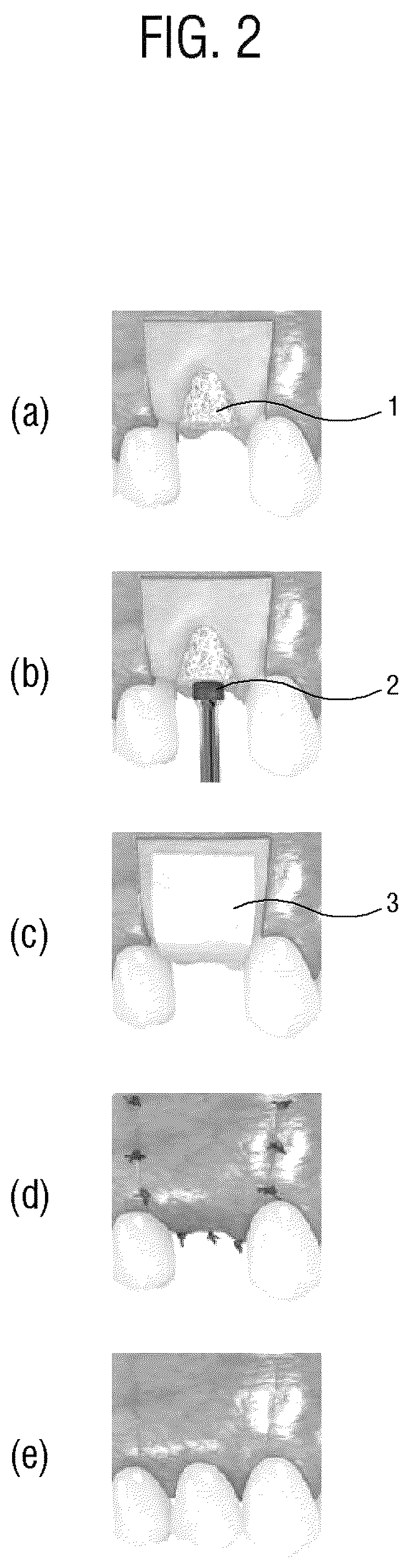 Patent US12318506 Figure 2 – Method for manufacturing ring-shaped bone grafting substitute