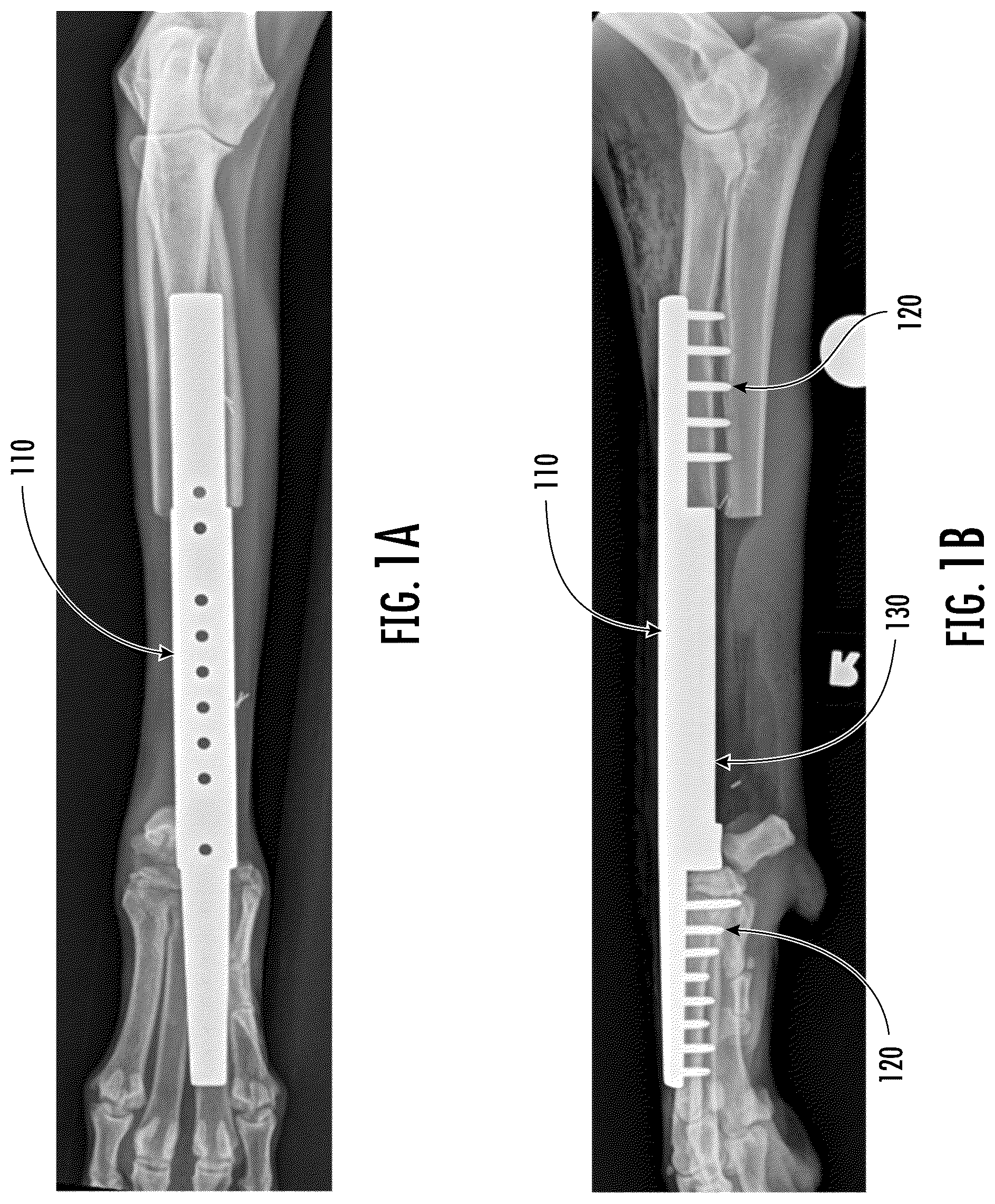 Patent US12318510 — Methods and devices for improving bone healing — Figure 1