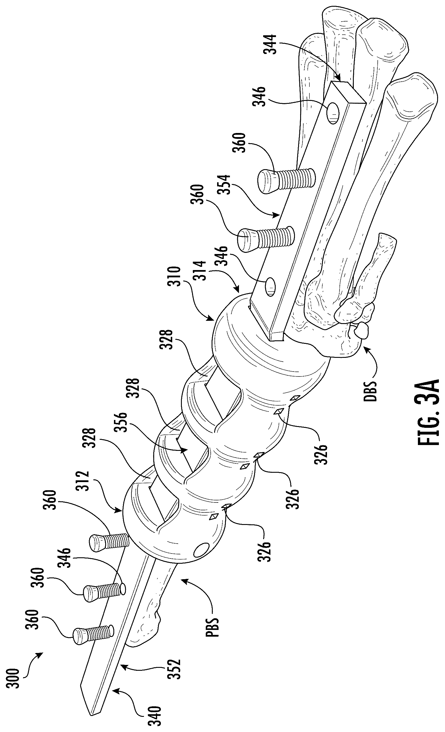 Patent US12318510 Figure 4 – Methods and devices for improving bone healing