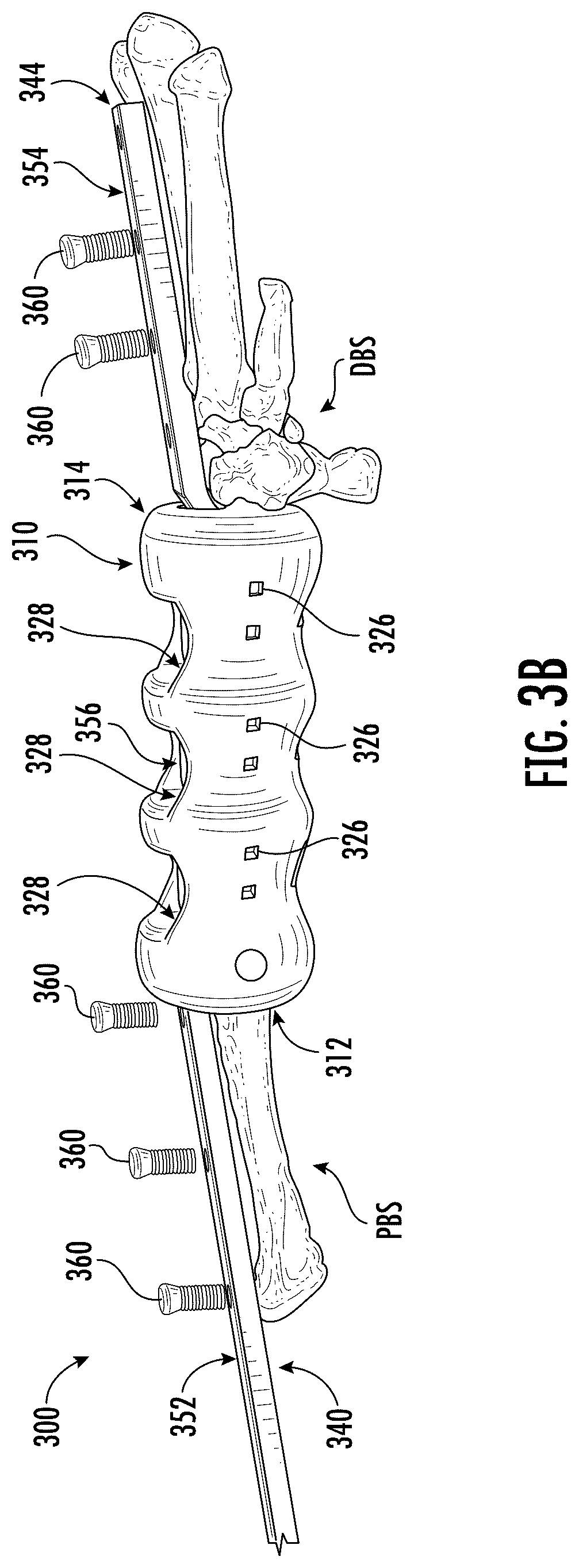 Patent US12318510 Figure 5 – Methods and devices for improving bone healing