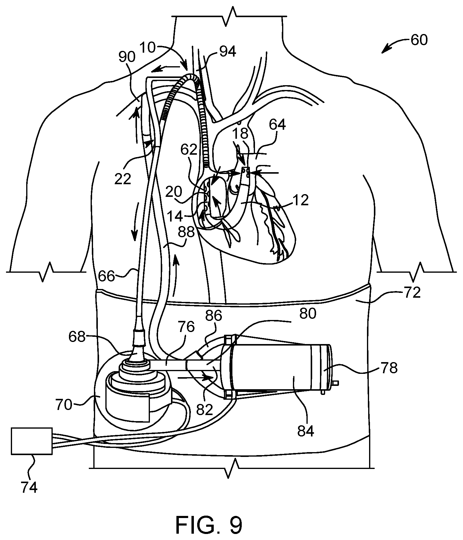 Patent US12318521 Figure 5 – VA ECMO with pulmonary artery ventilation