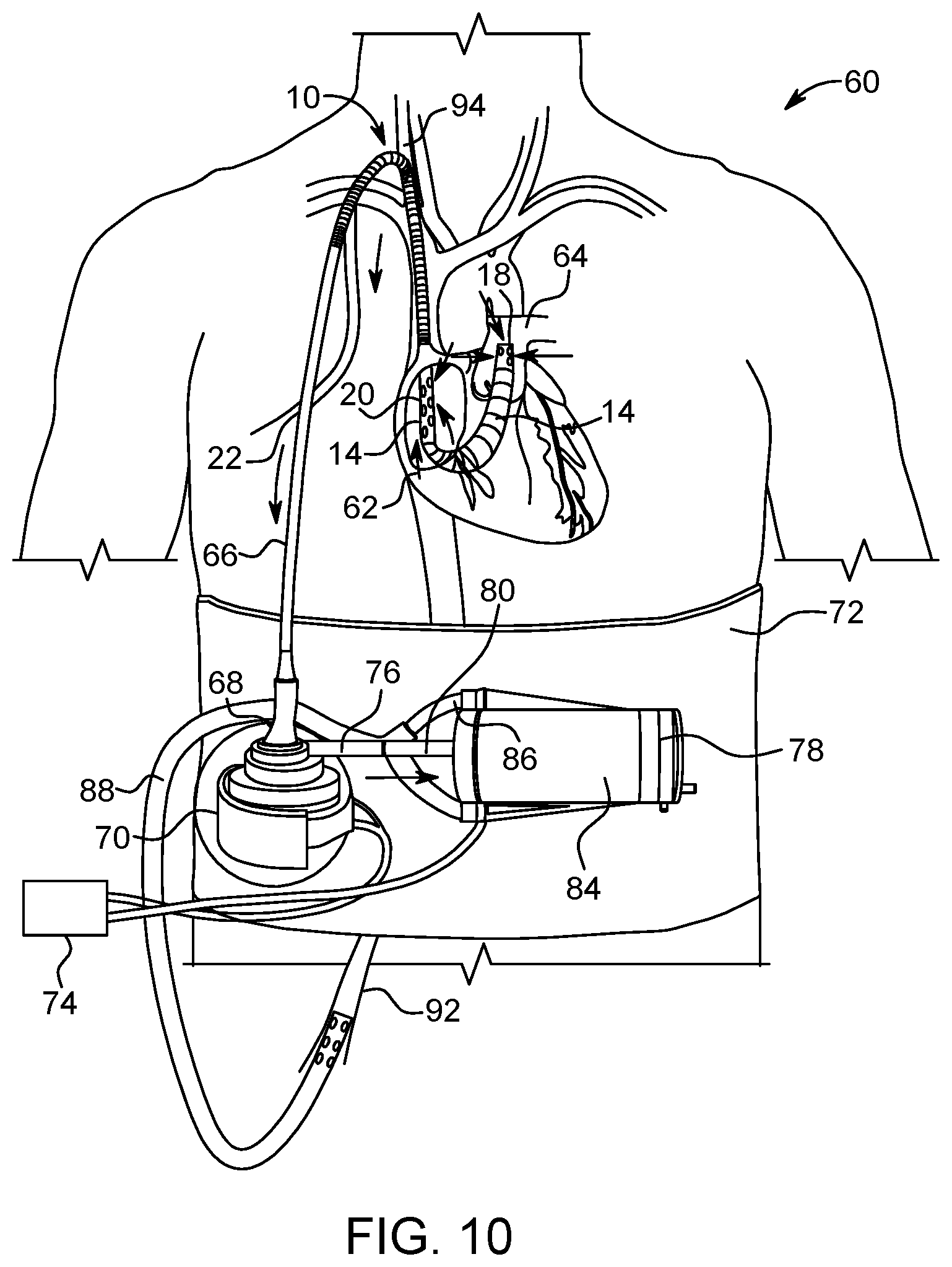 Patent US12318521 Figure 6 – VA ECMO with pulmonary artery ventilation