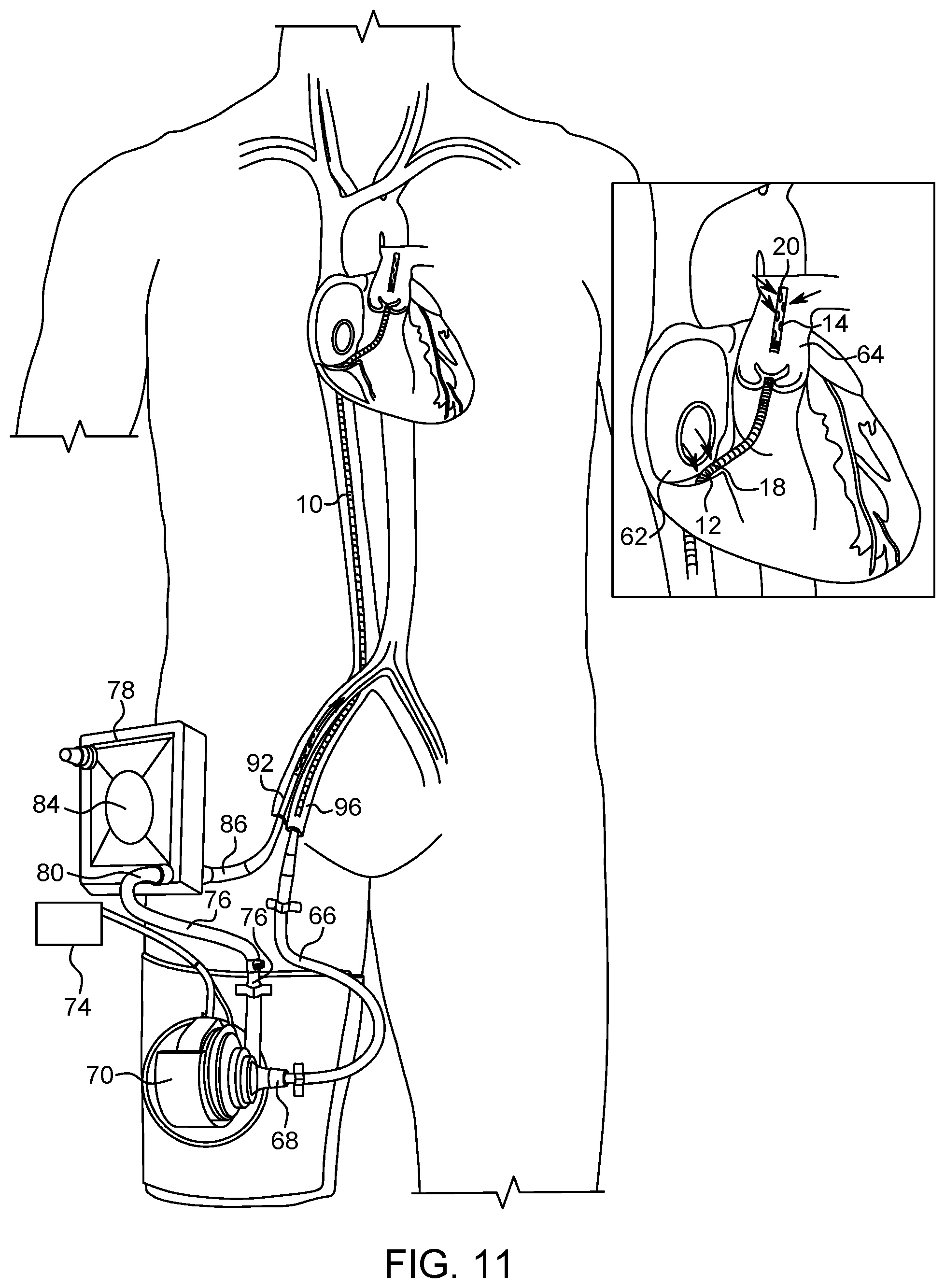 Patent US12318521 Figure 7 – VA ECMO with pulmonary artery ventilation