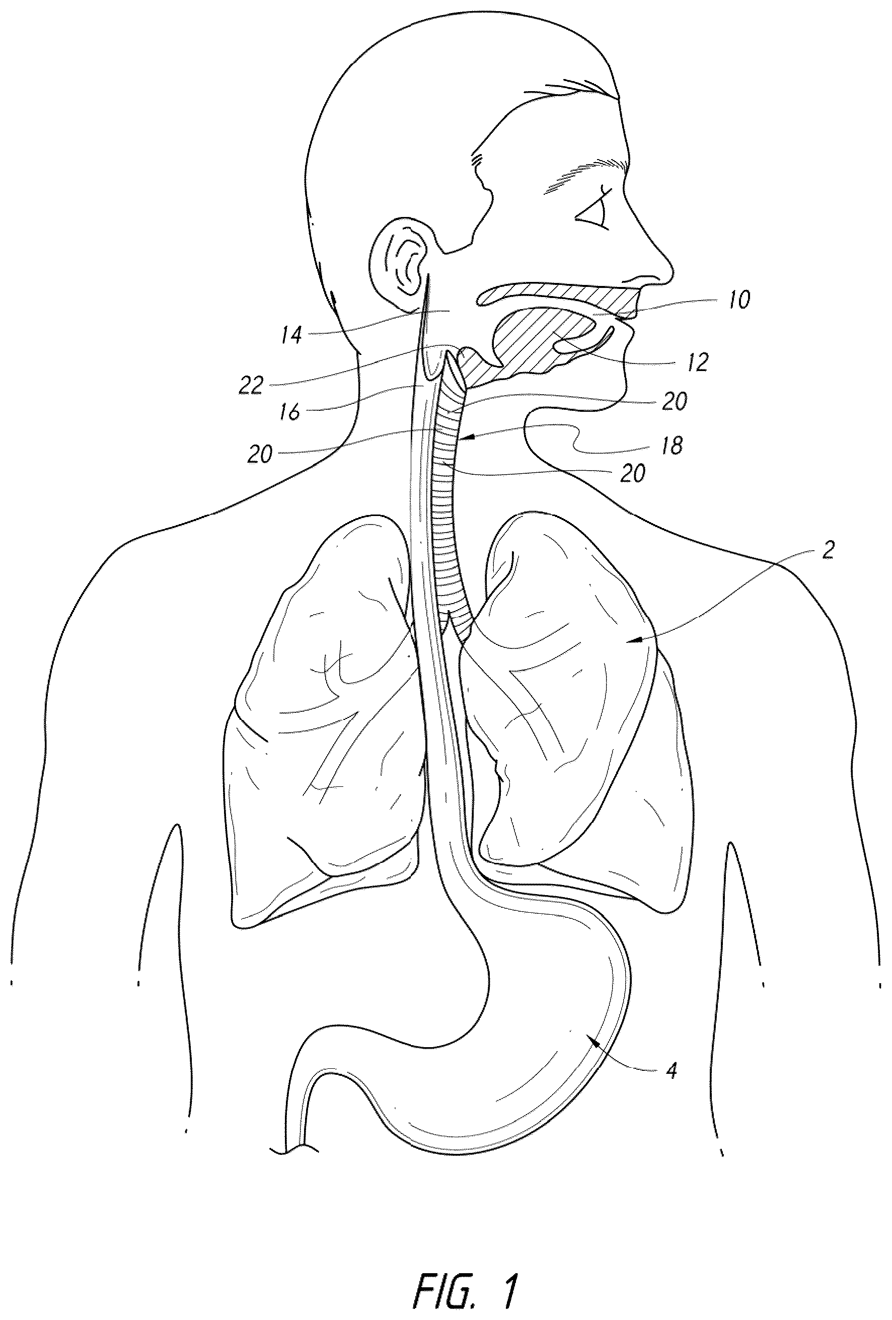 Patent US12318539 Figure 1 – Apparatus and method for improved assisted ventilation