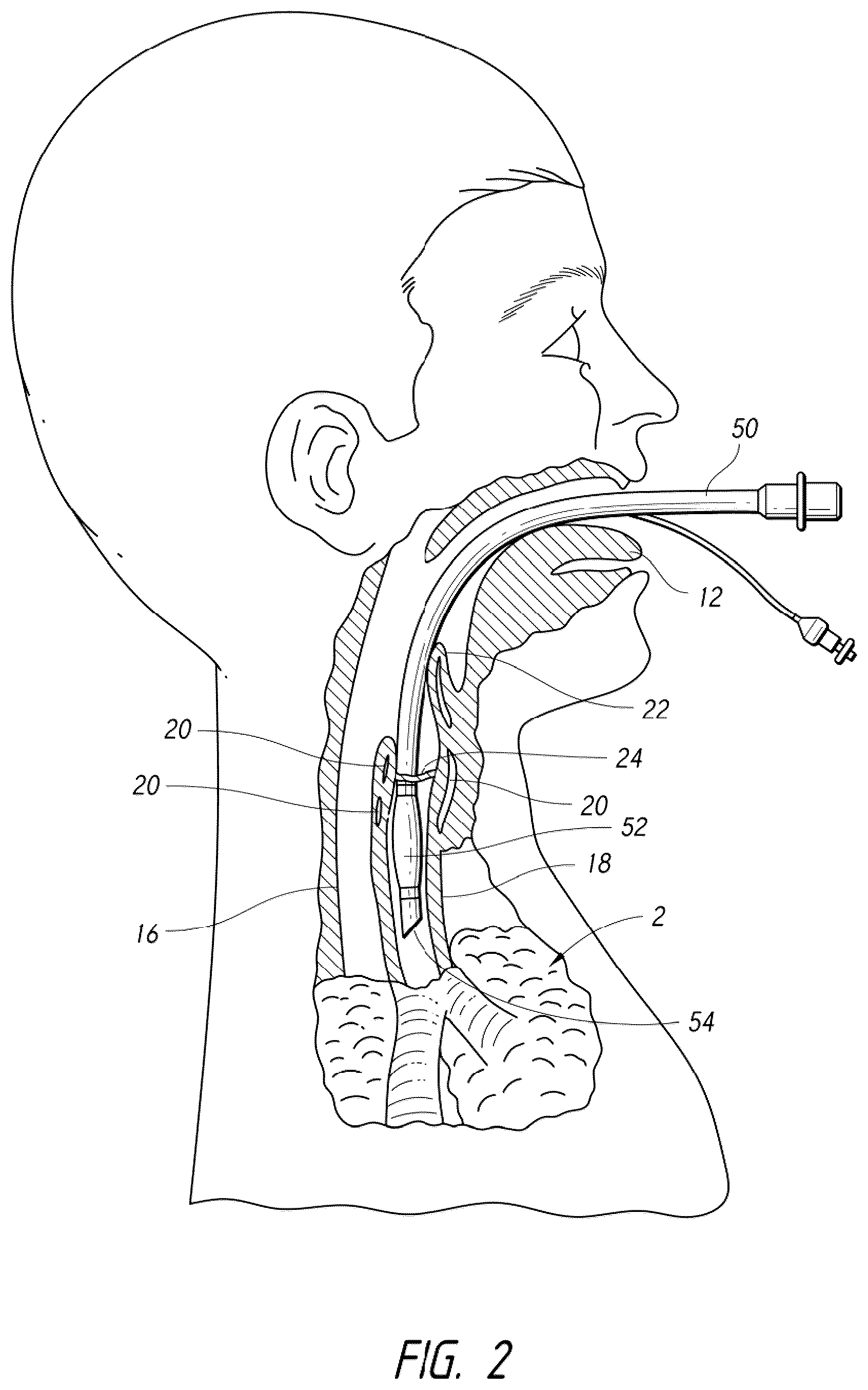 Patent US12318539 Figure 2 – Apparatus and method for improved assisted ventilation