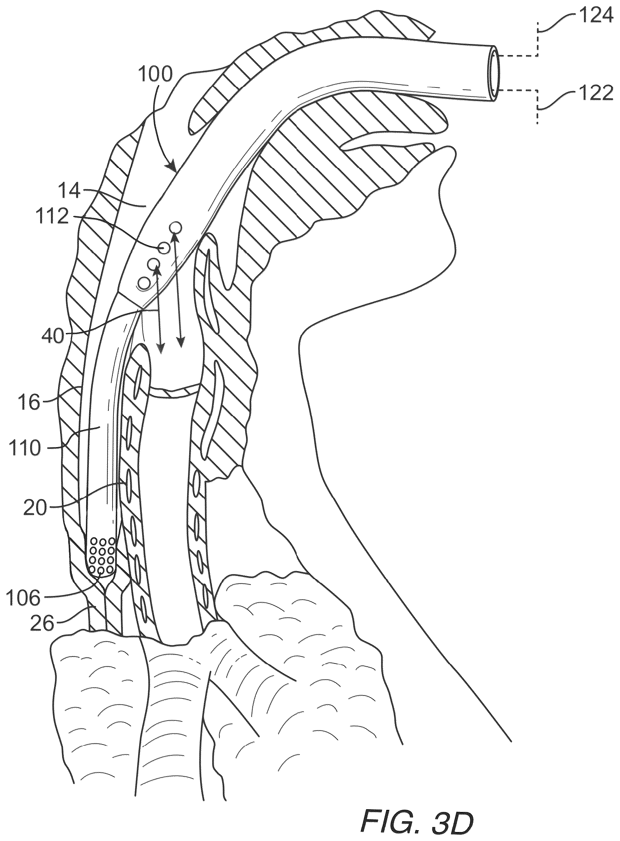 Patent US12318539 Figure 5 – Apparatus and method for improved assisted ventilation