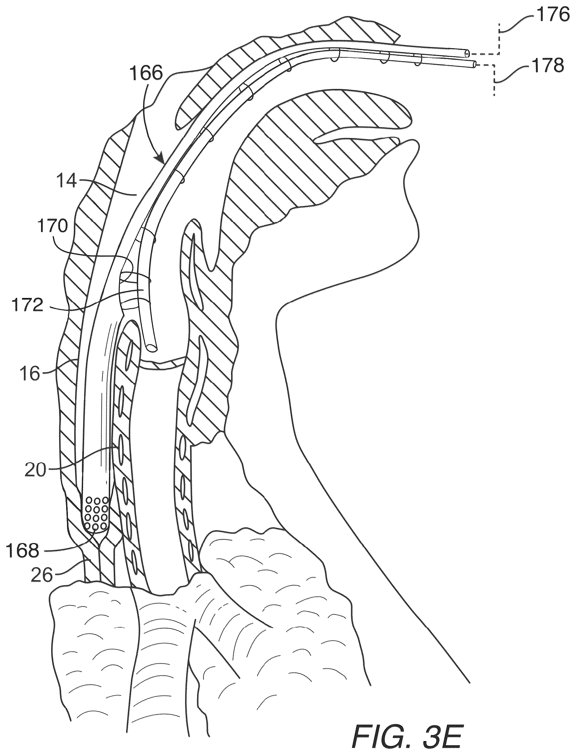 Patent US12318539 Figure 6 – Apparatus and method for improved assisted ventilation