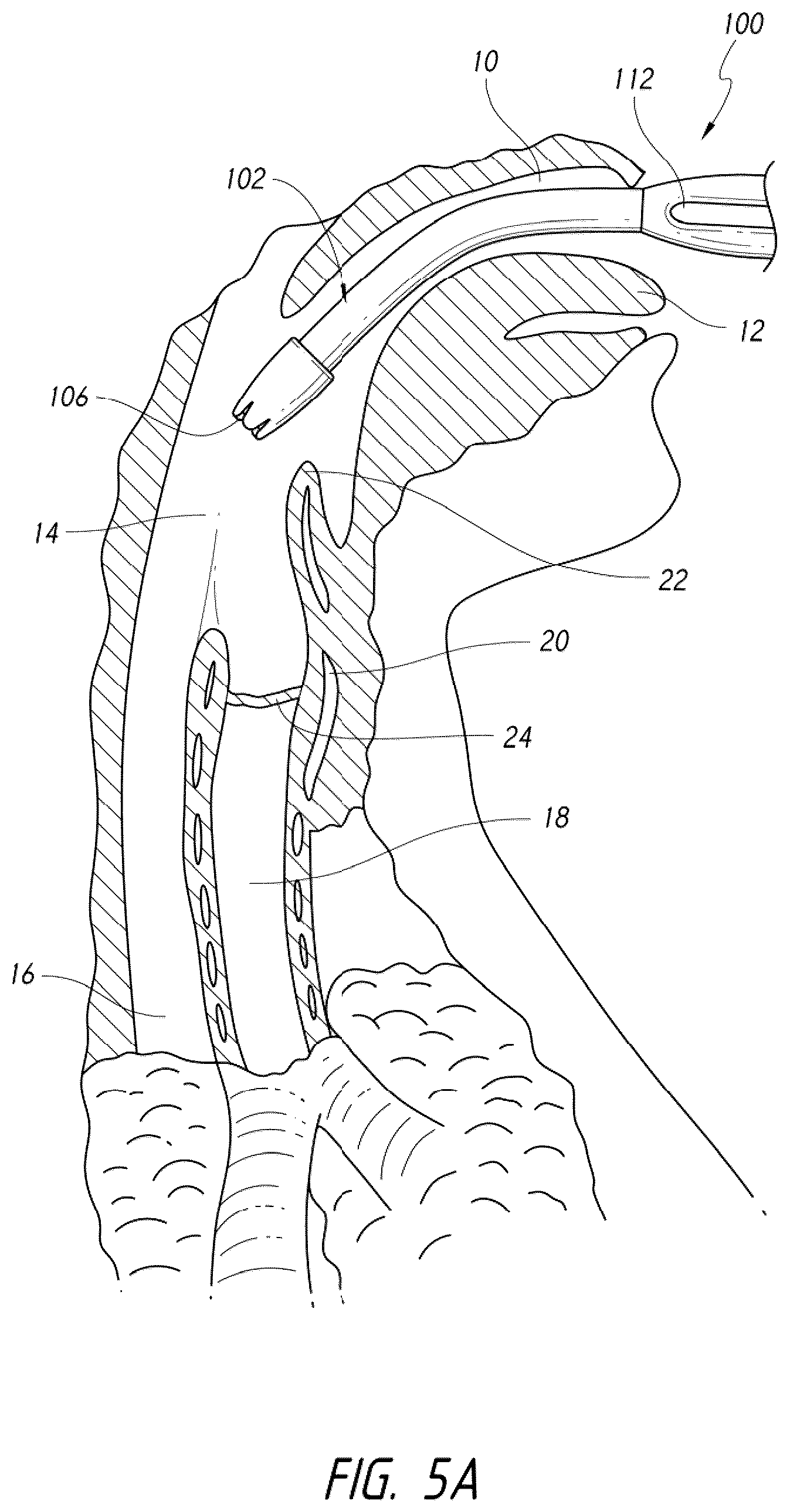 Patent US12318539 Figure 9 – Apparatus and method for improved assisted ventilation