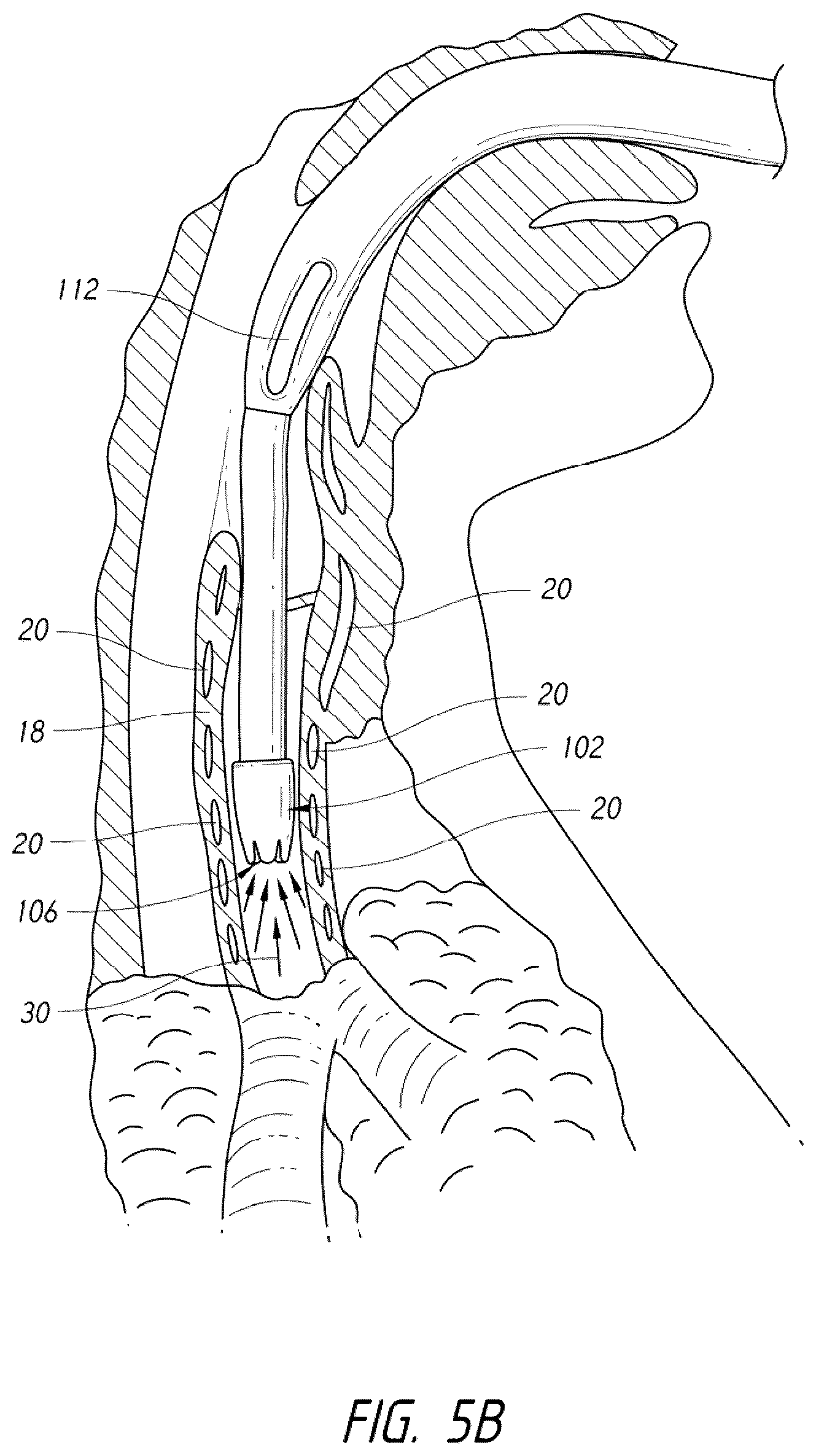 Patent US12318539 Figure 10 – Apparatus and method for improved assisted ventilation