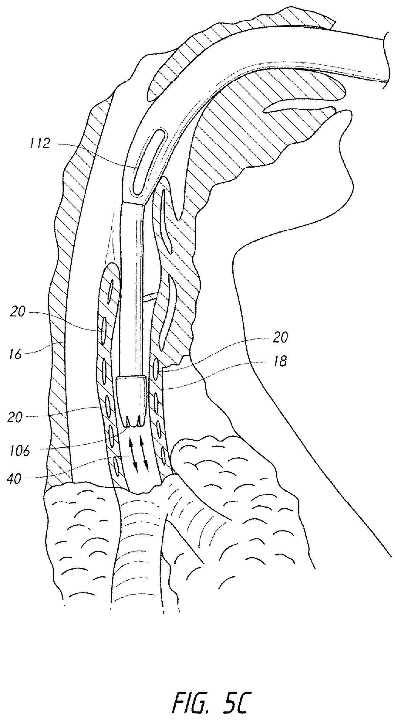 Patent US12318539 Figure 11 – Apparatus and method for improved assisted ventilation