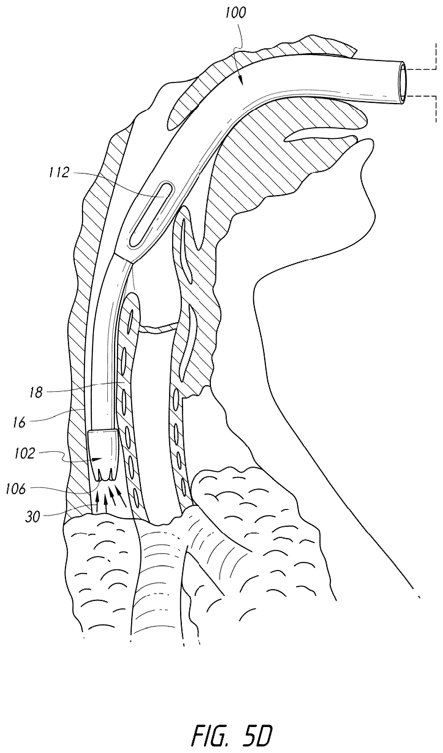 Patent US12318539 Figure 12 – Apparatus and method for improved assisted ventilation