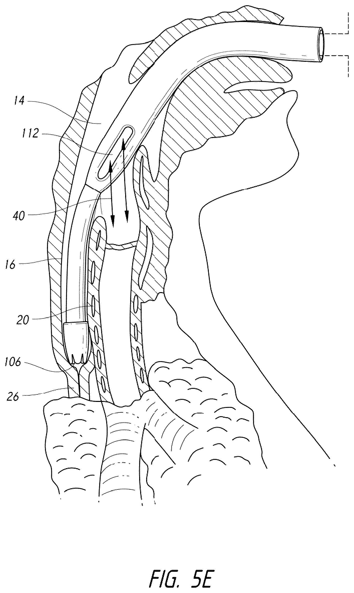 Patent US12318539 Figure 13 – Apparatus and method for improved assisted ventilation