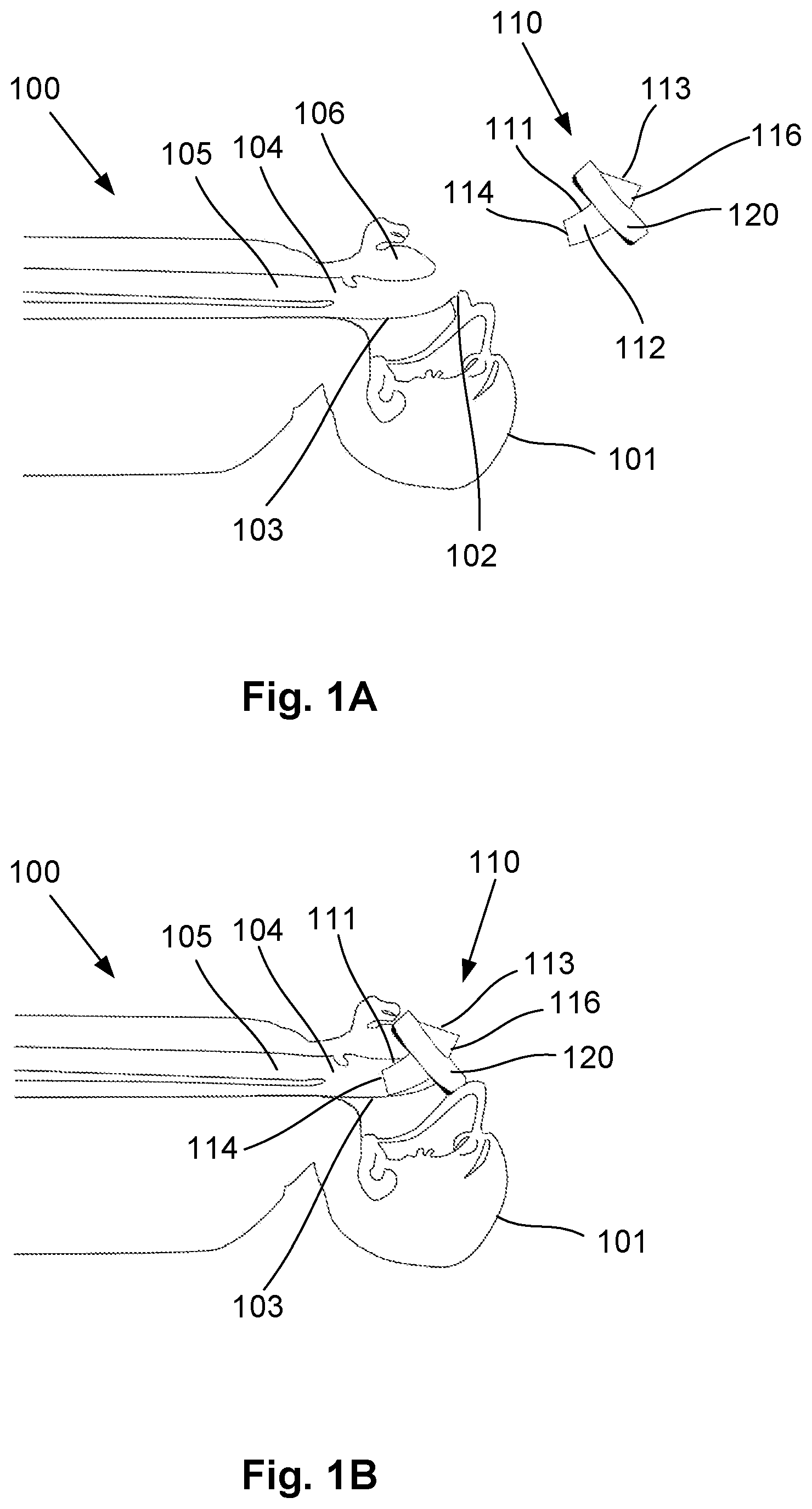 Patent US12318541 Figure 1 – Shielded intubation guide and method