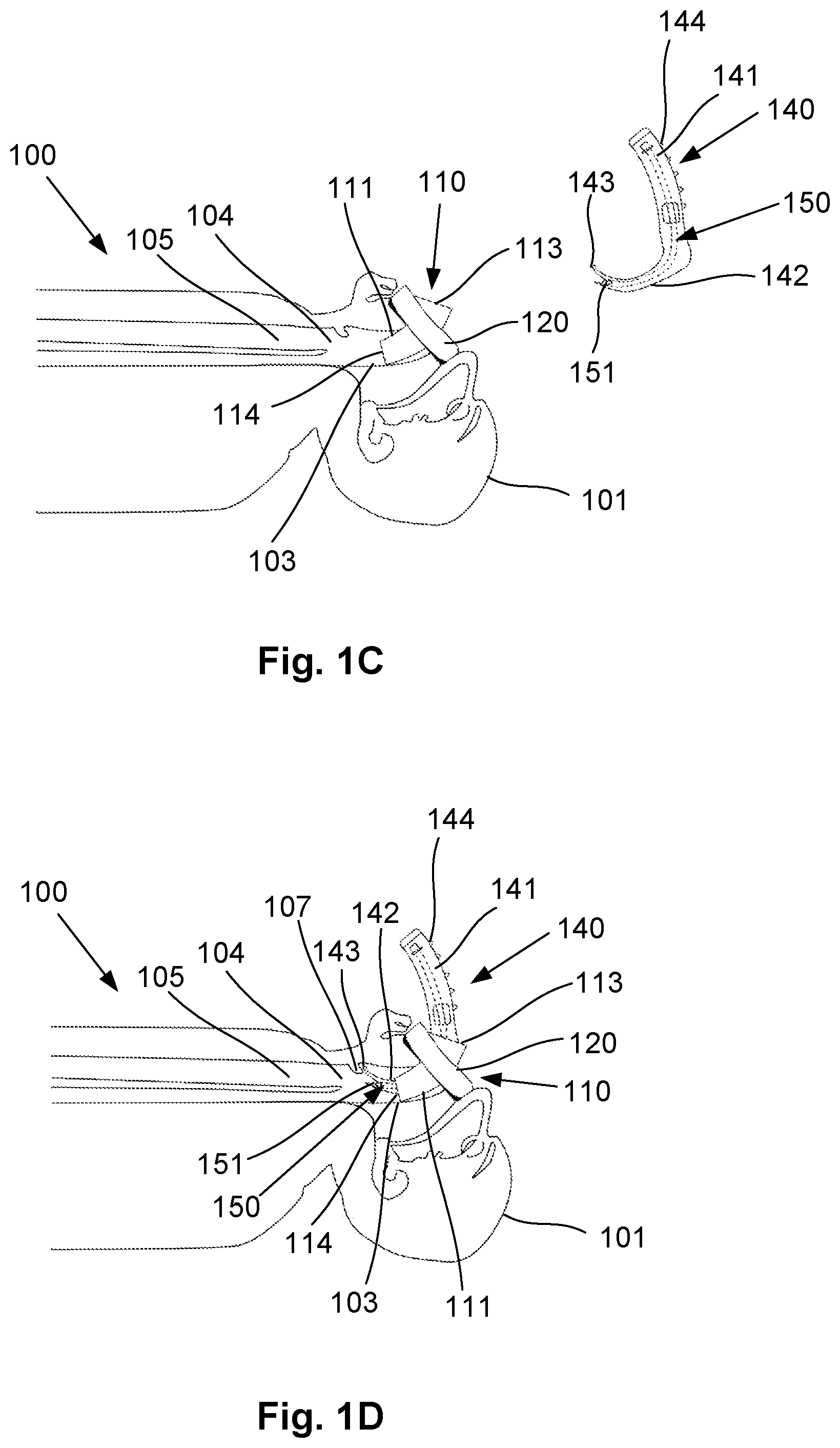 Patent US12318541 Figure 2 – Shielded intubation guide and method