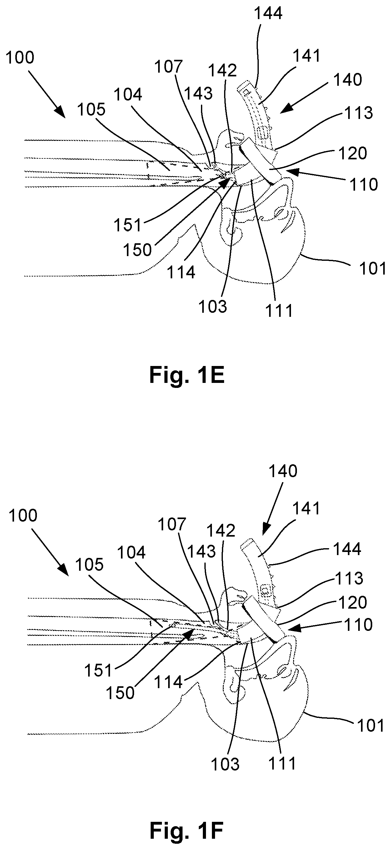 Patent US12318541 Figure 3 – Shielded intubation guide and method