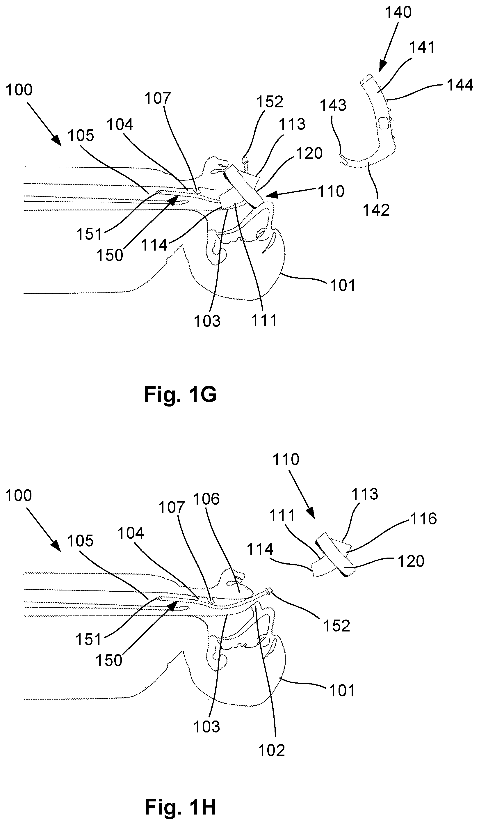 Patent US12318541 Figure 4 – Shielded intubation guide and method