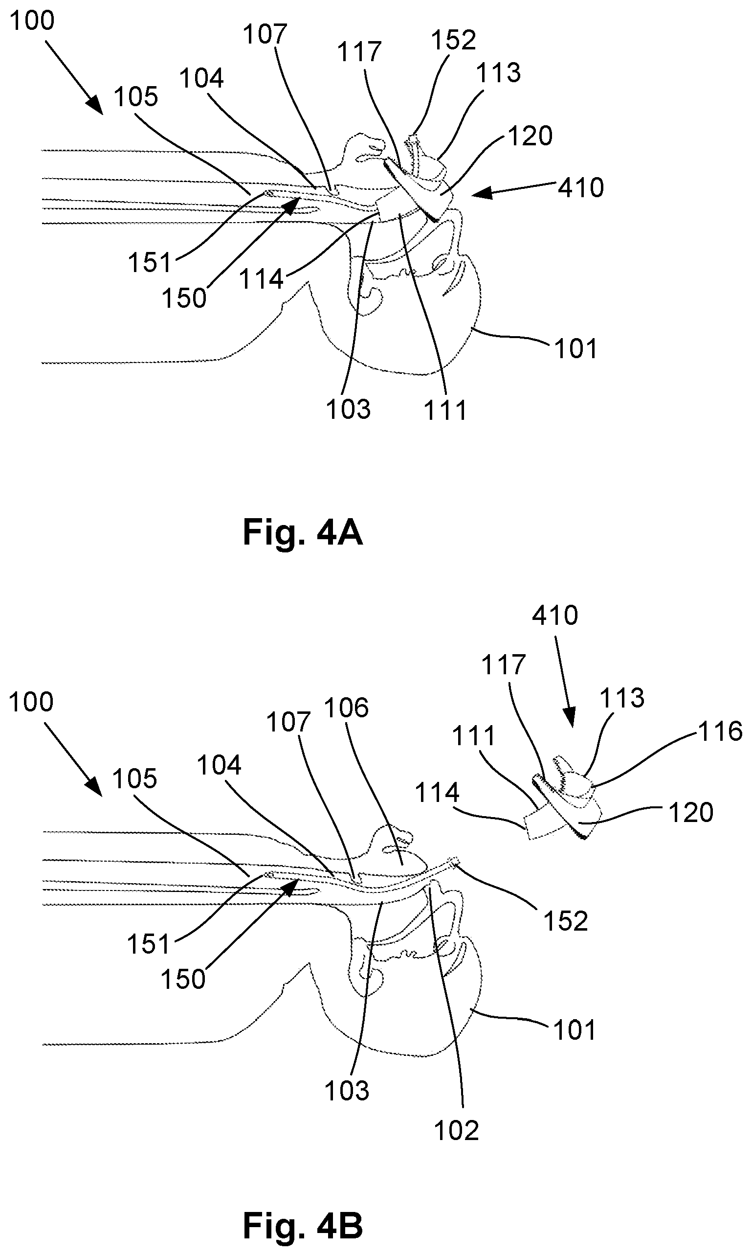 Patent US12318541 Figure 8 – Shielded intubation guide and method