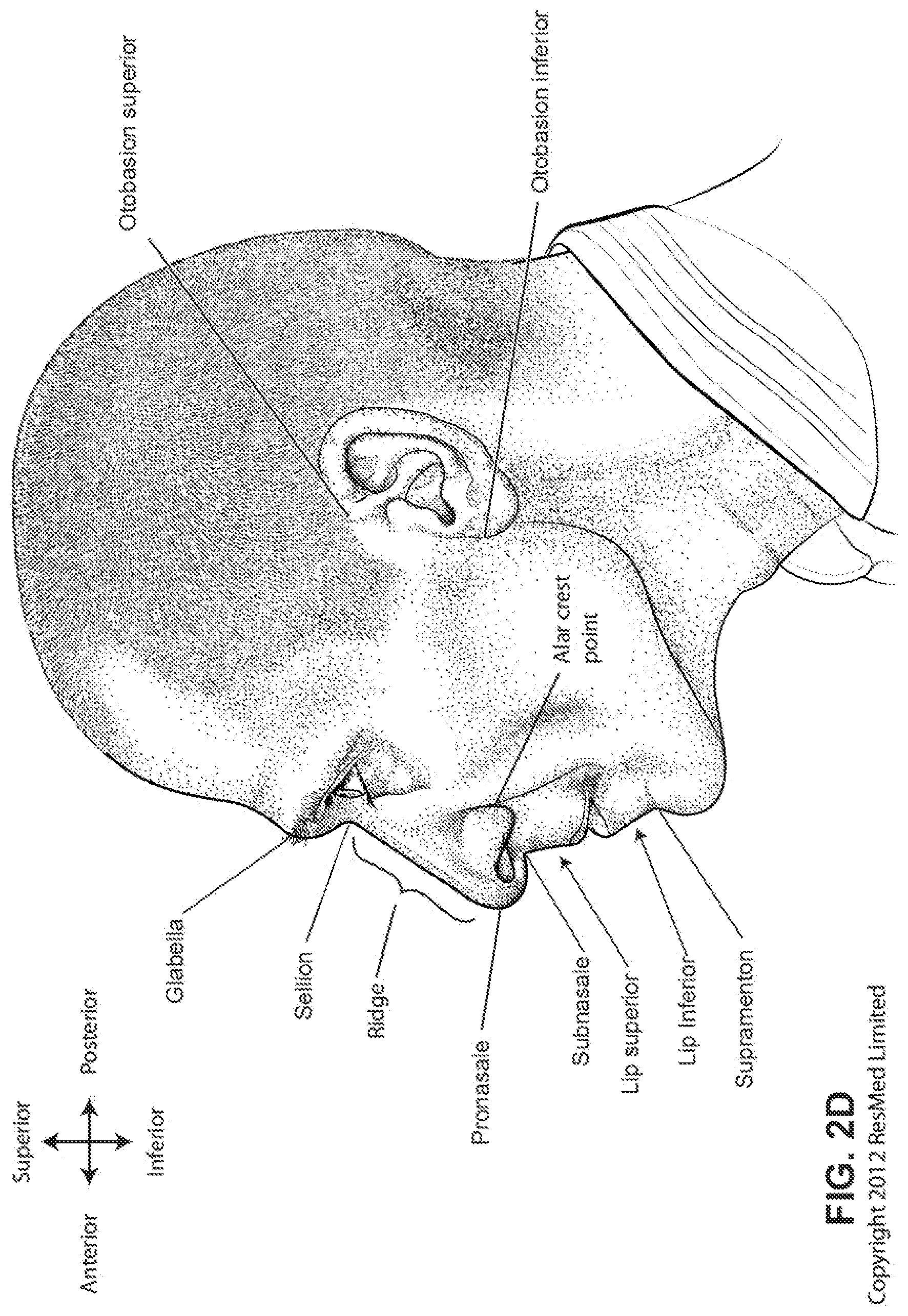 Patent US12318544 Figure 7 – Elbow assembly