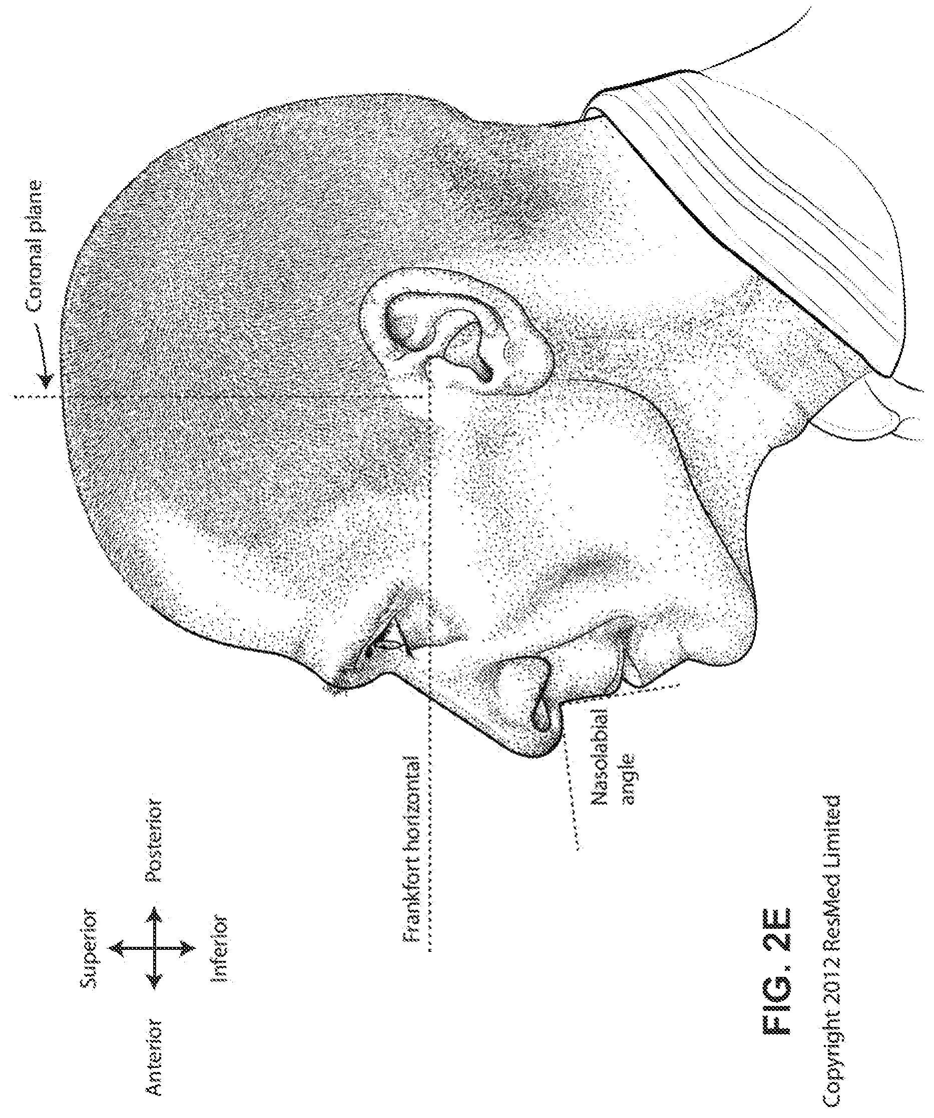 Patent US12318544 Figure 8 – Elbow assembly