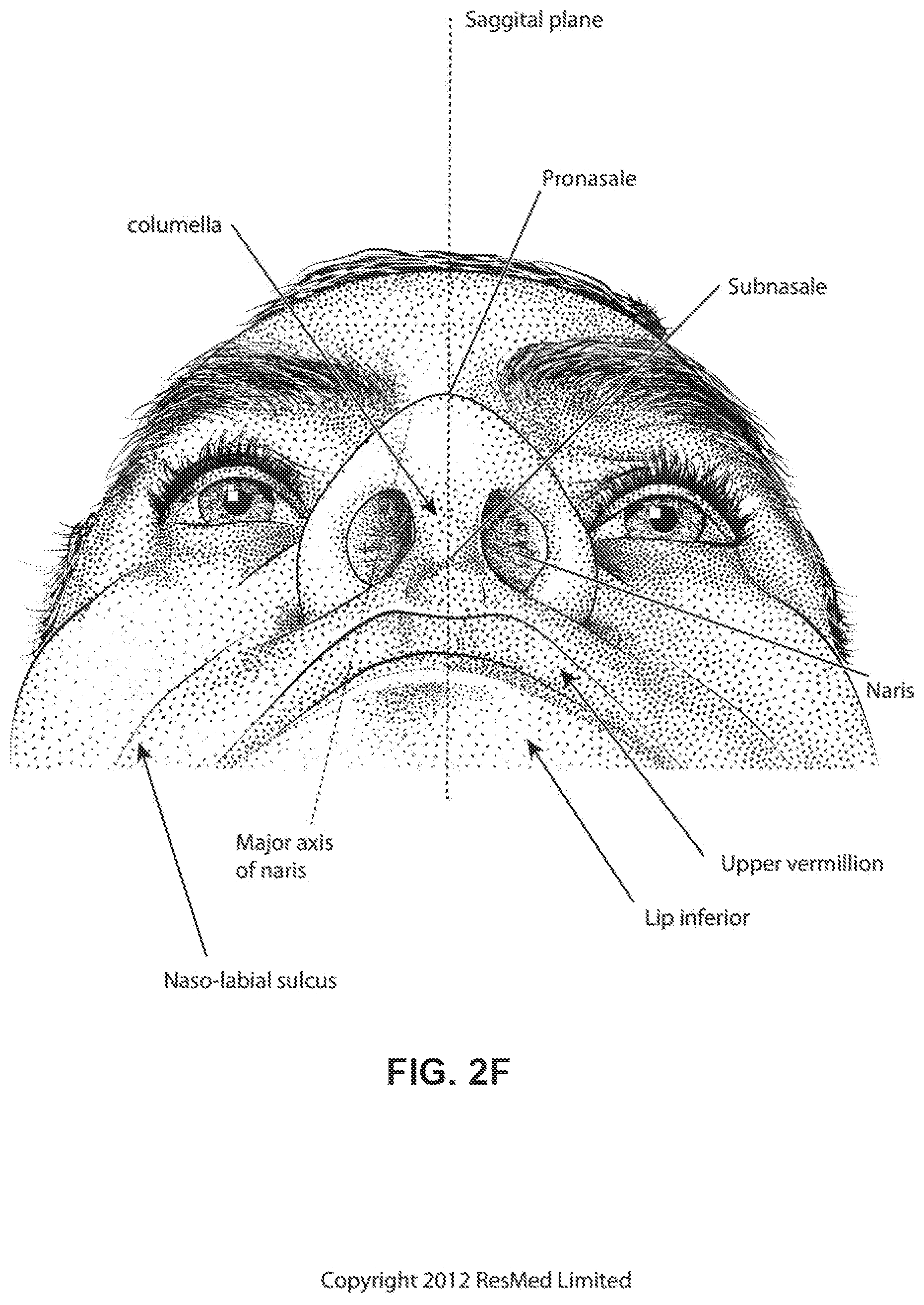Patent US12318544 Figure 9 – Elbow assembly