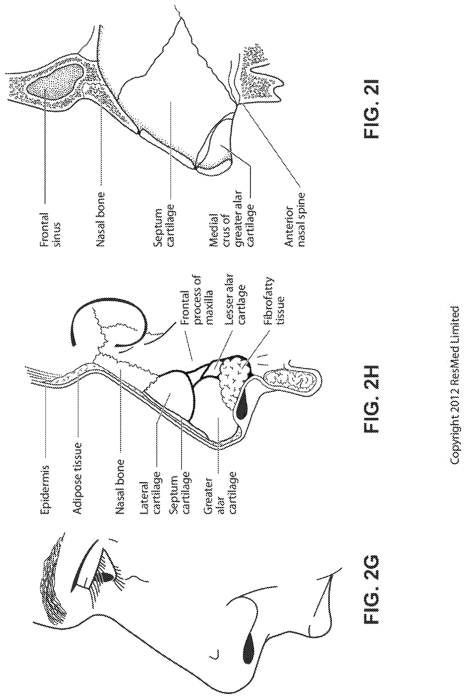 Patent US12318544 Figure 10 – Elbow assembly