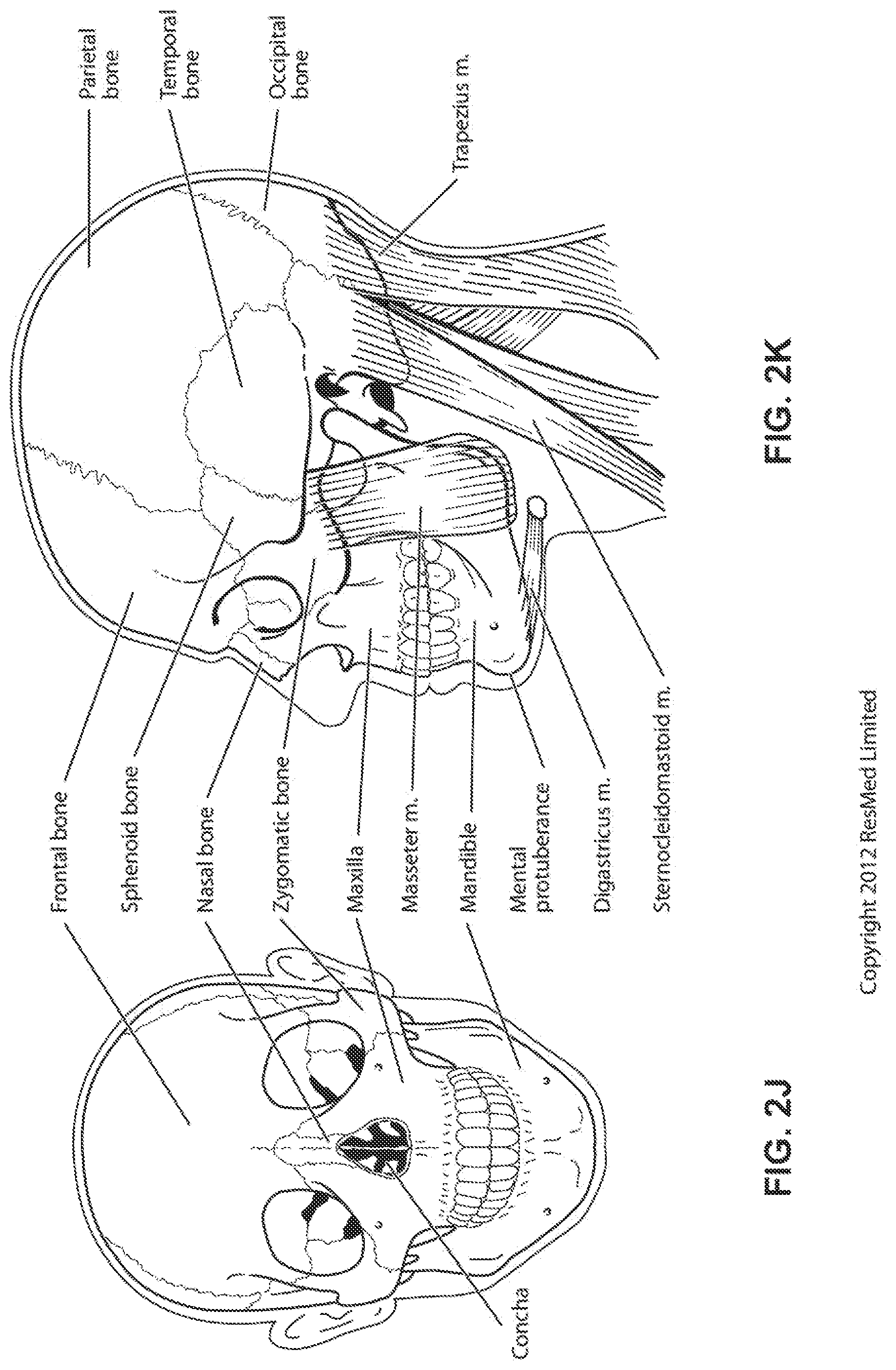Patent US12318544 Figure 11 – Elbow assembly