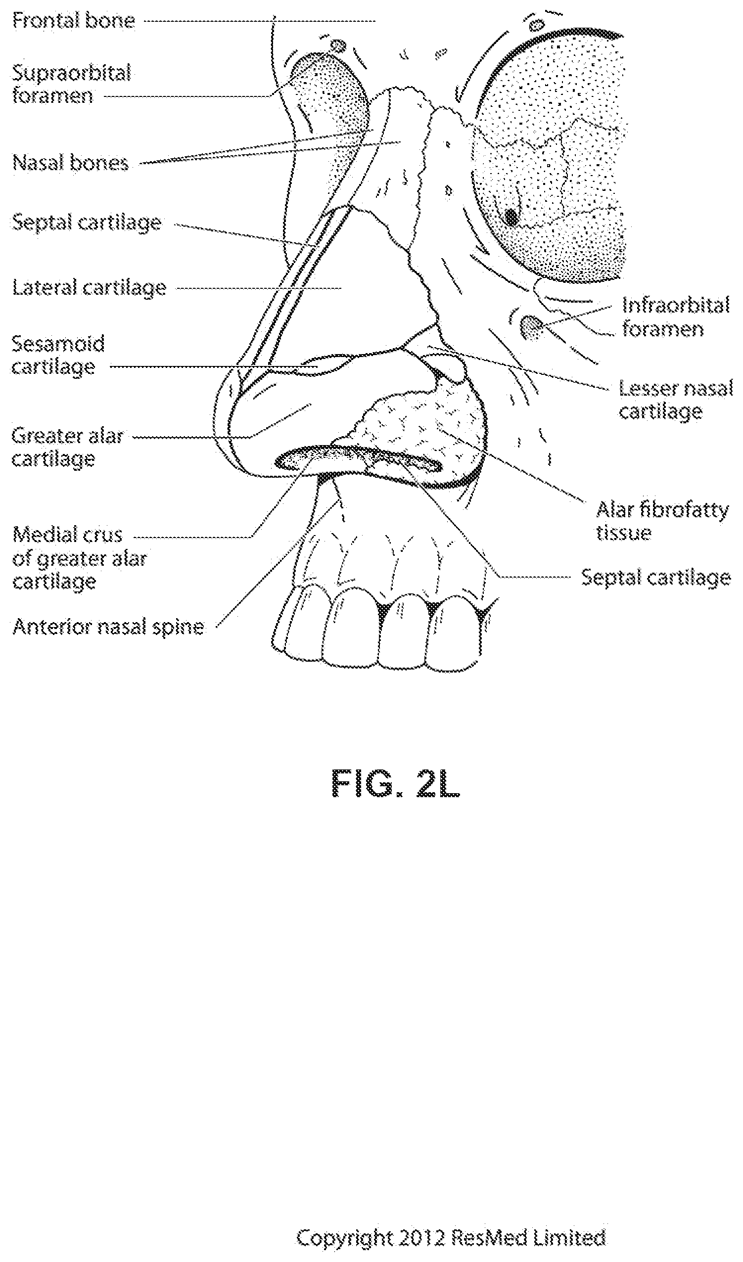 Patent US12318544 Figure 12 – Elbow assembly