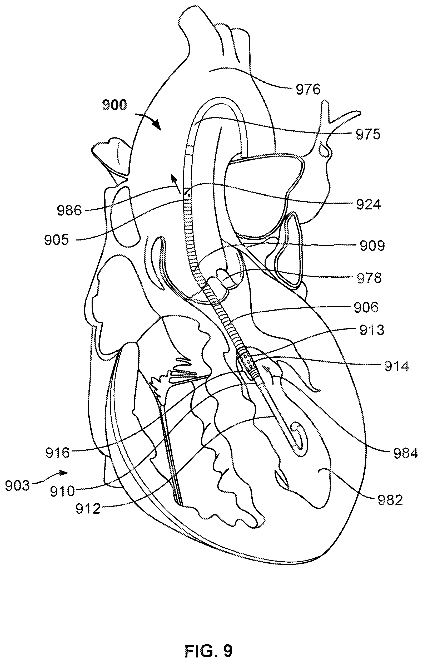 Patent US12318551 Figure 8 – Cannula having nitinol reinforced inflow region