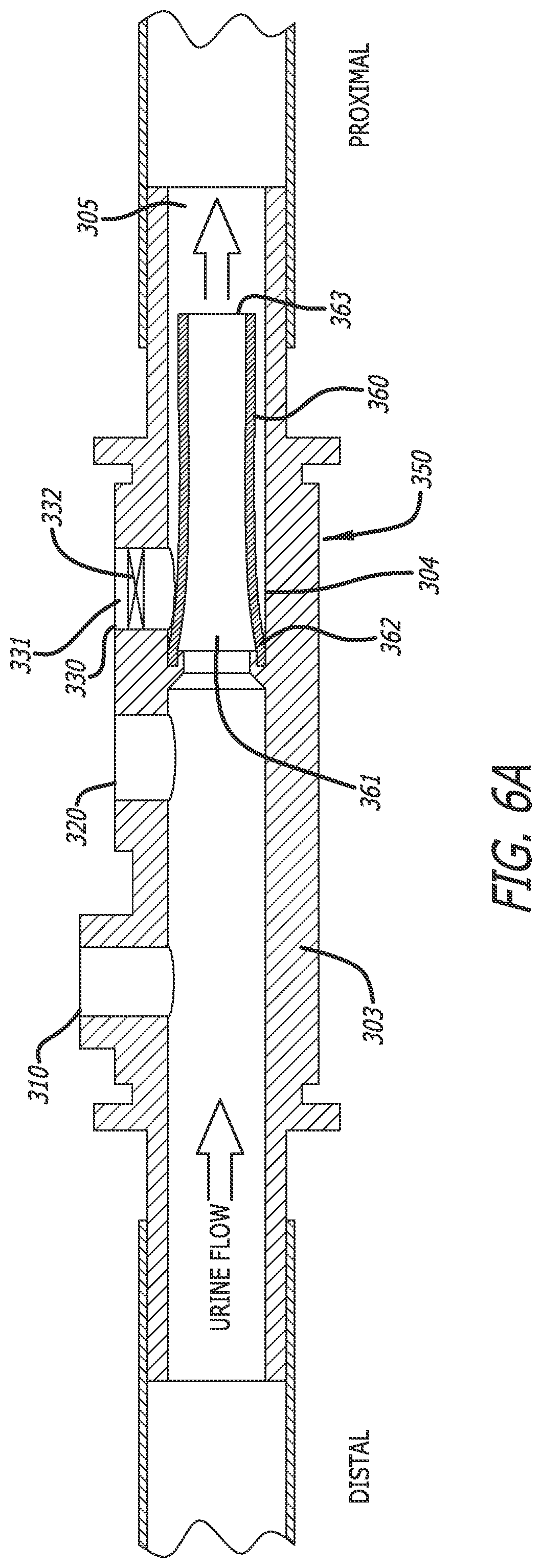 Patent US12318552 Figure 8 – Collapsible thin-walled valve for drainage control