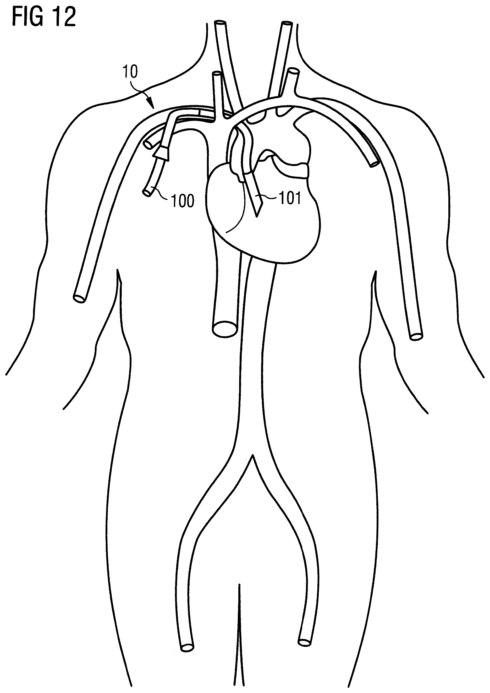 Patent US12318560 Figure 8 – Introducer sheath