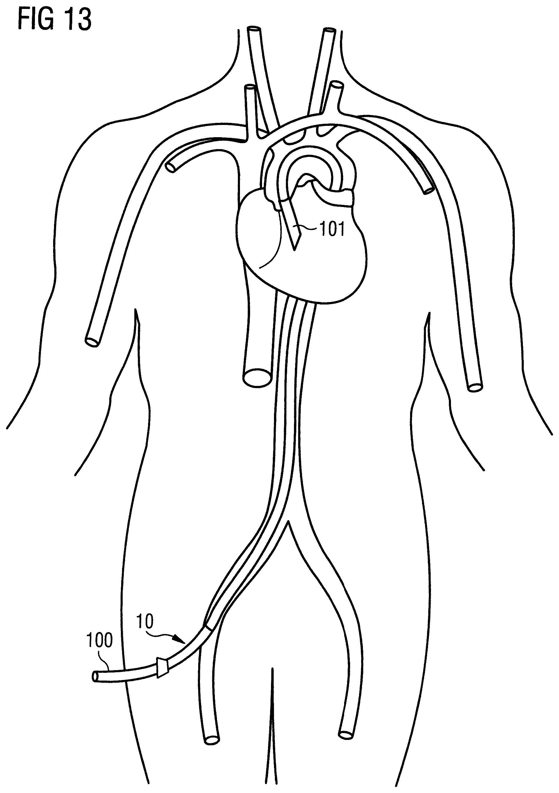 Patent US12318560 Figure 9 – Introducer sheath
