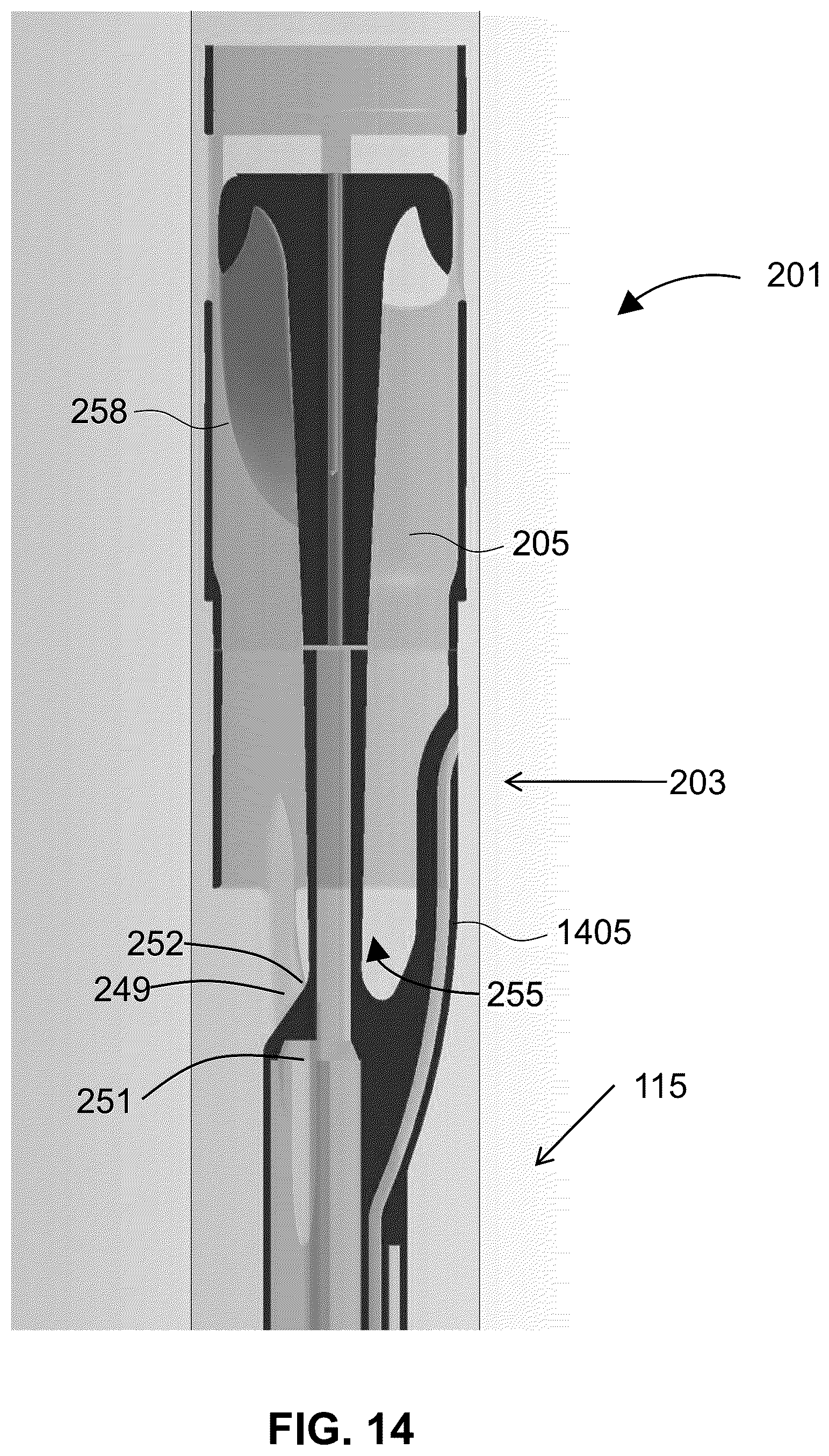 Patent US12318561 Figure 14 – Devices and methods for treating edema