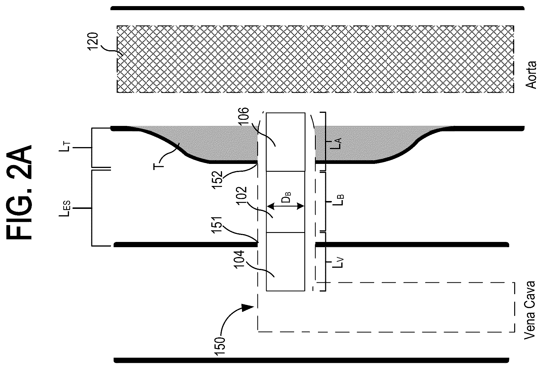 Patent US12318563 Figure 3 – Methods and systems for transcaval treatment of aneurysms