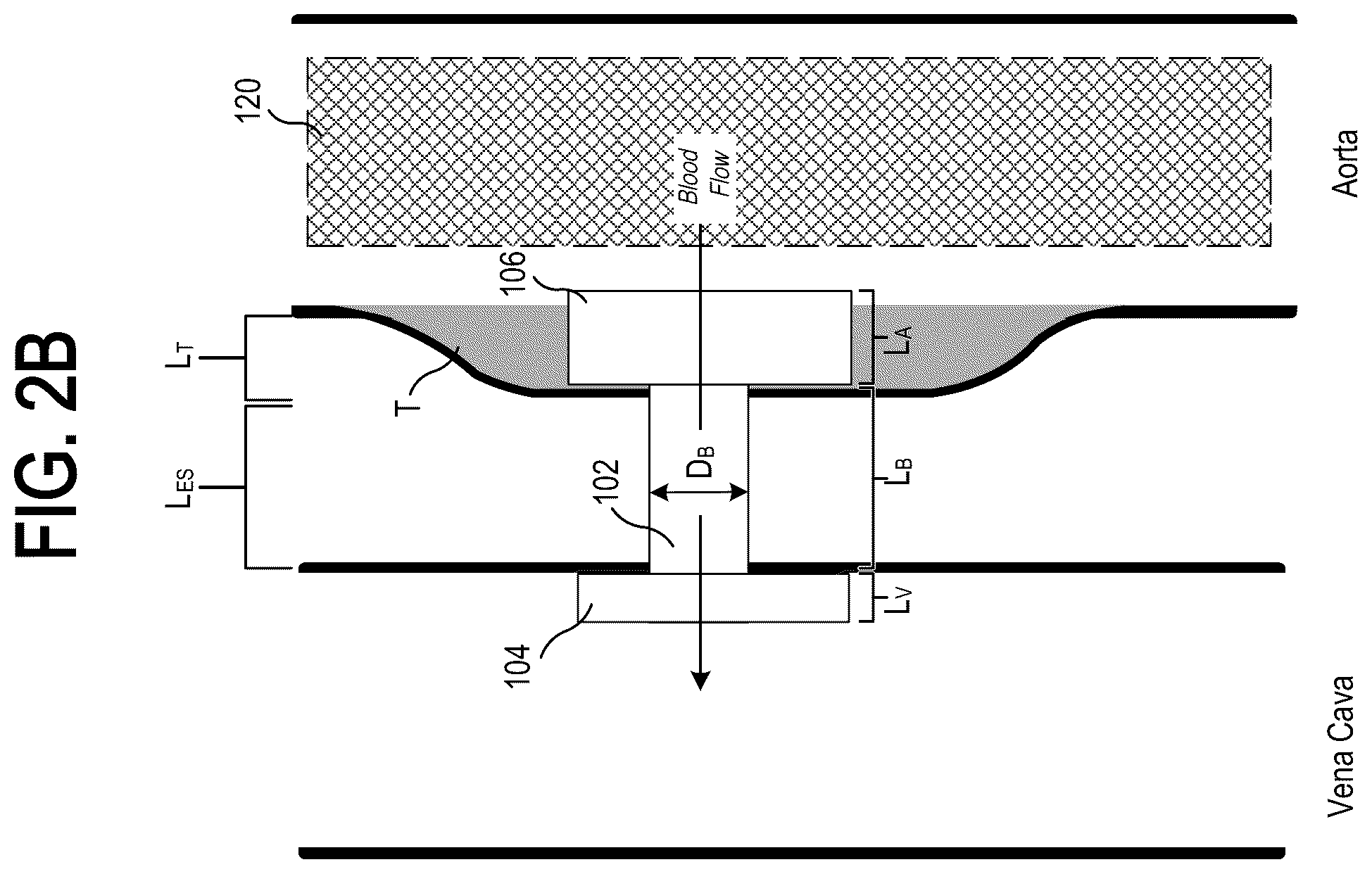 Patent US12318563 Figure 4 – Methods and systems for transcaval treatment of aneurysms
