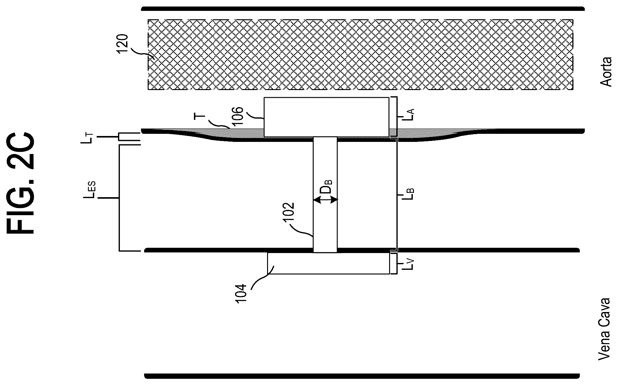 Patent US12318563 Figure 5 – Methods and systems for transcaval treatment of aneurysms