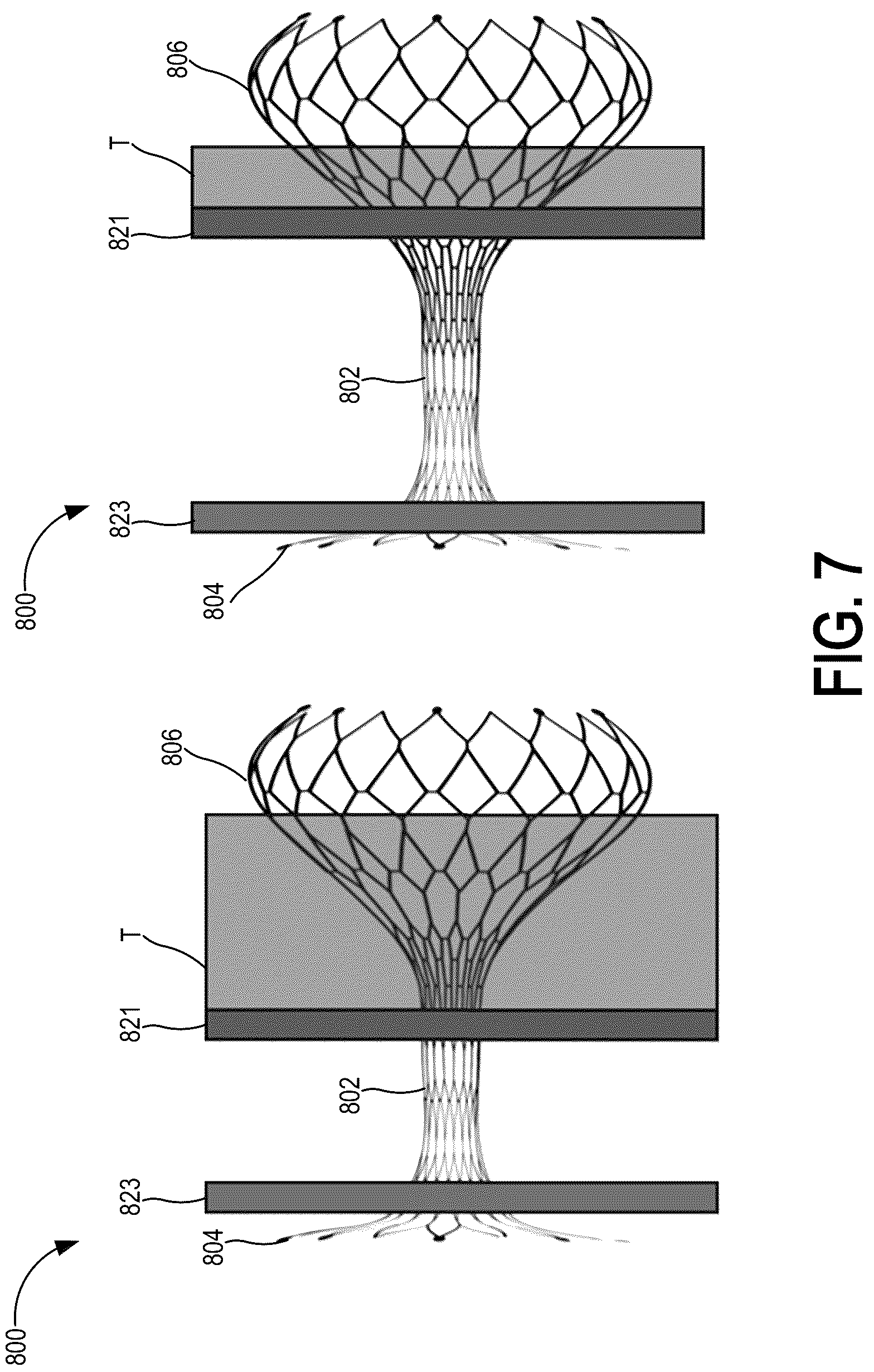 Patent US12318563 Figure 13 – Methods and systems for transcaval treatment of aneurysms