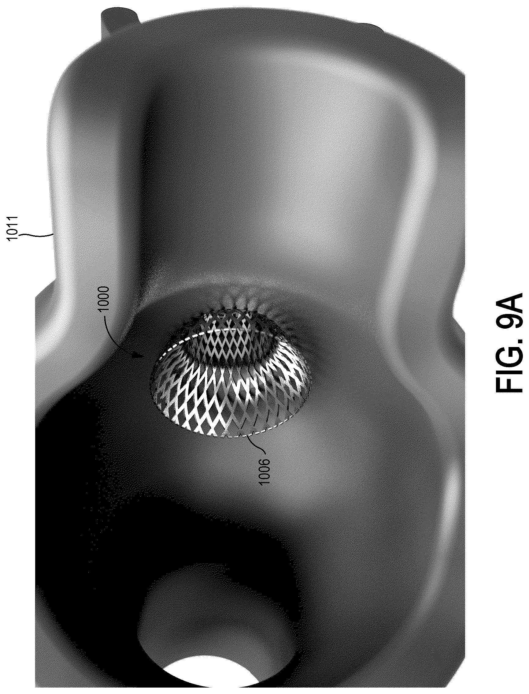 Patent US12318563 Figure 15 – Methods and systems for transcaval treatment of aneurysms