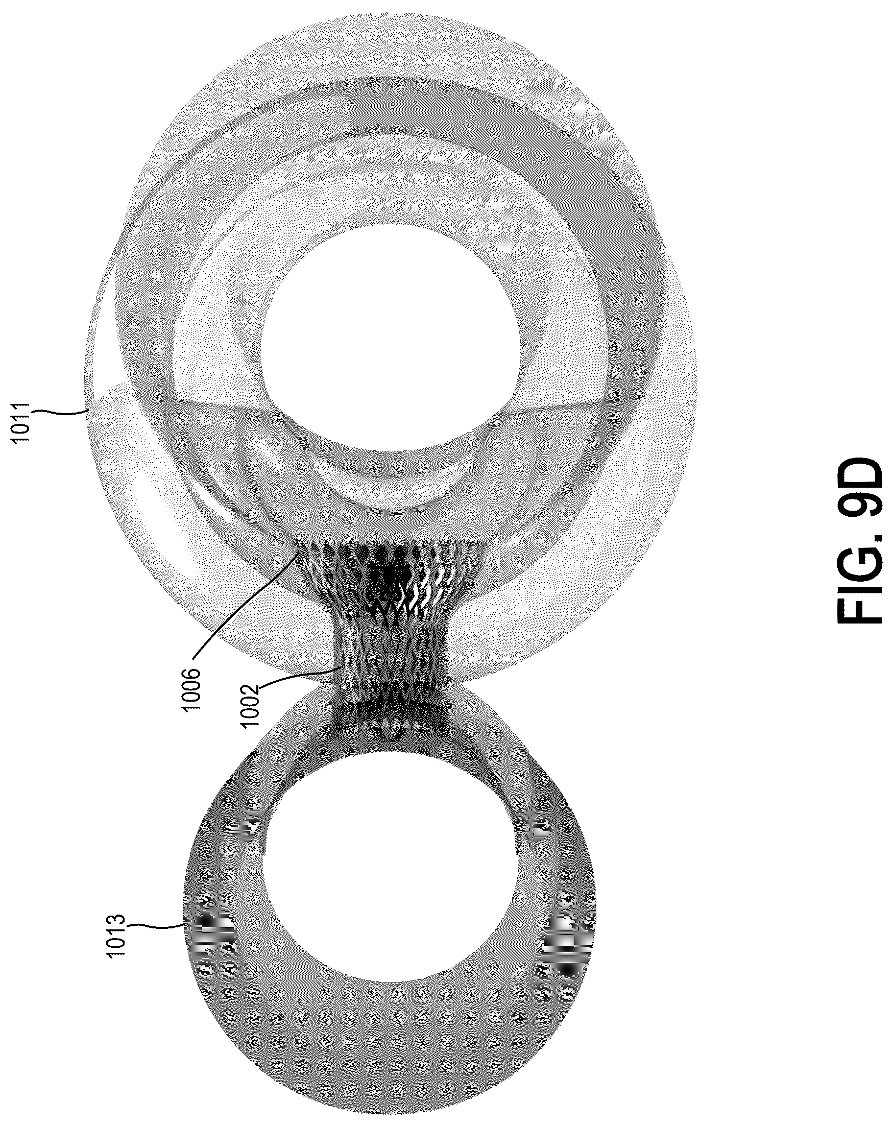 Patent US12318563 Figure 18 – Methods and systems for transcaval treatment of aneurysms