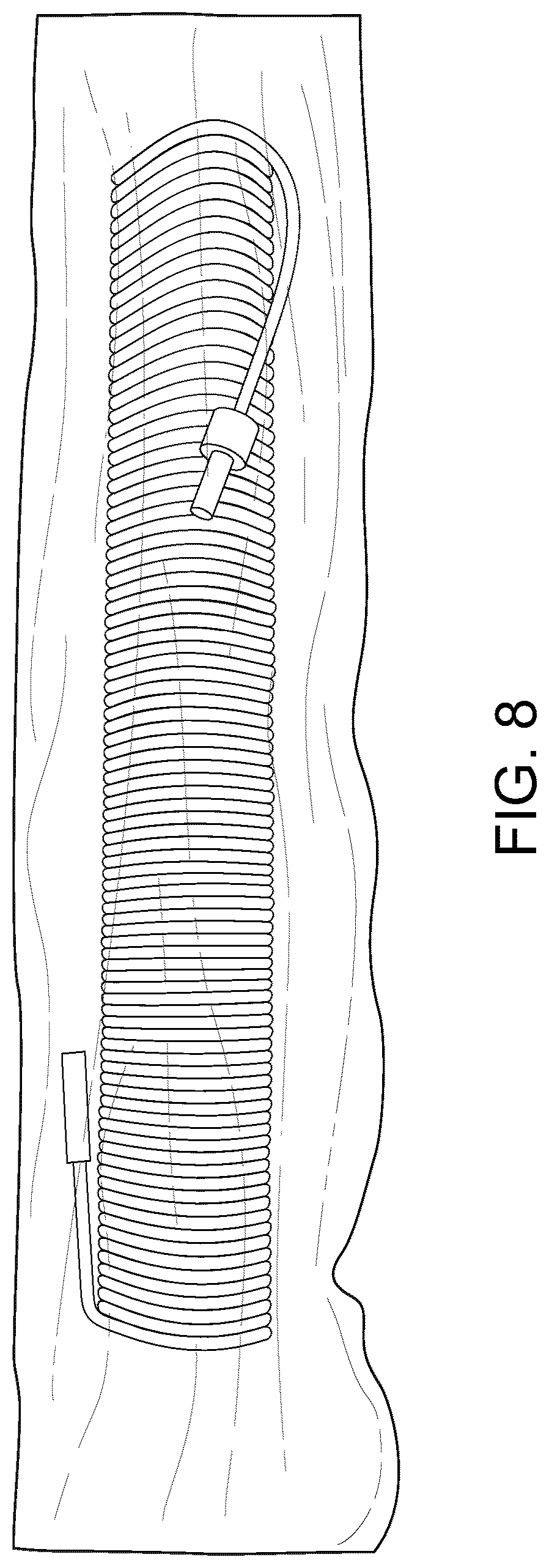 Patent US12318568 Figure 8 – Medical coiled tubing