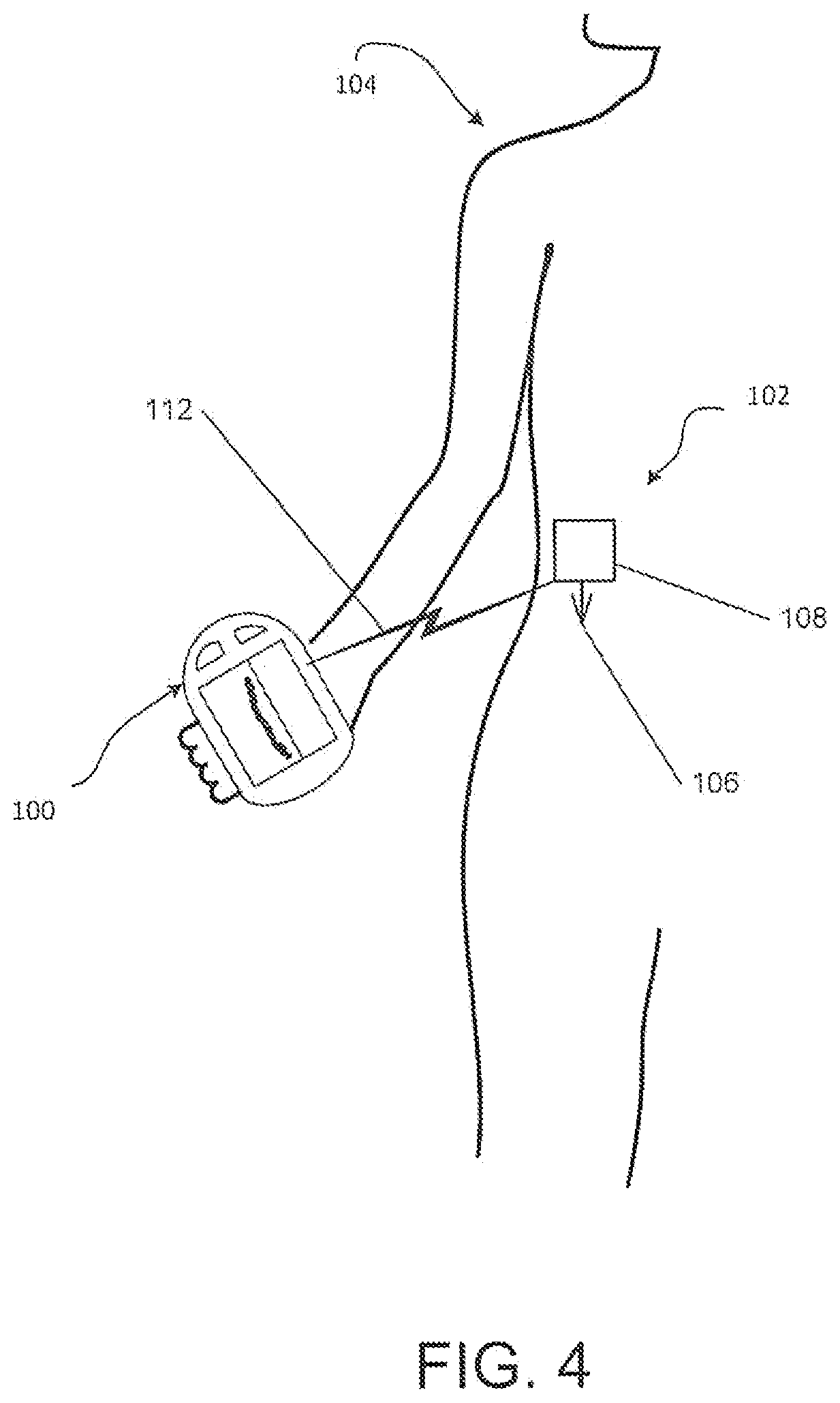 Patent US12318578 Figure 4 – System and method for switching between closed loop and open loop control of an ambulatory infusion pump