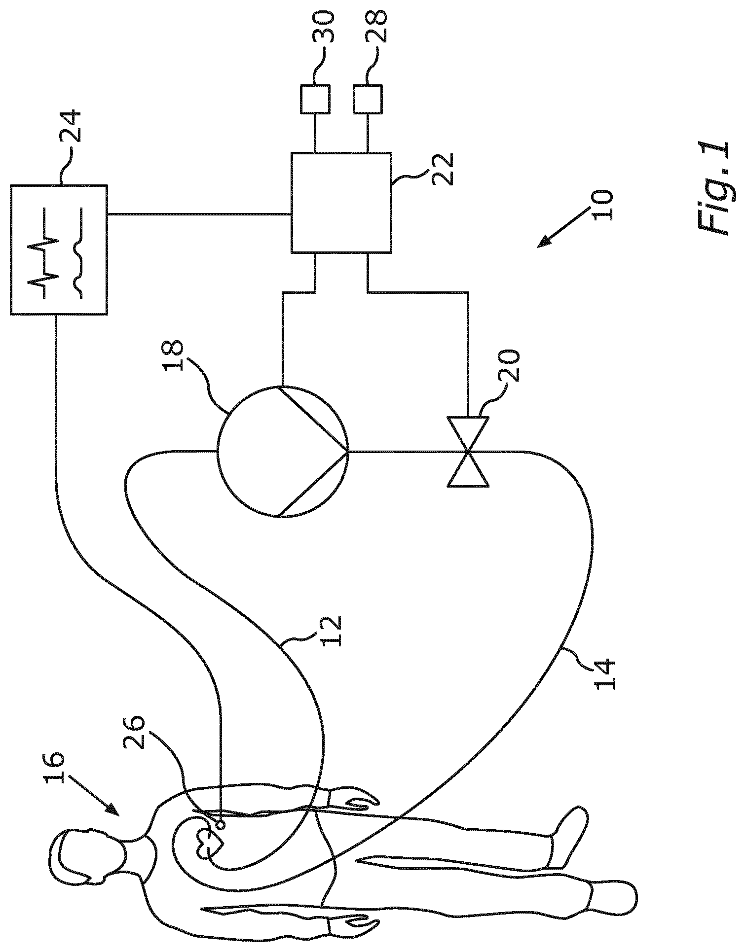 Patent US12318602 Figure 1 – System for cardiac assistance, method for operating the system and cardiac support method
