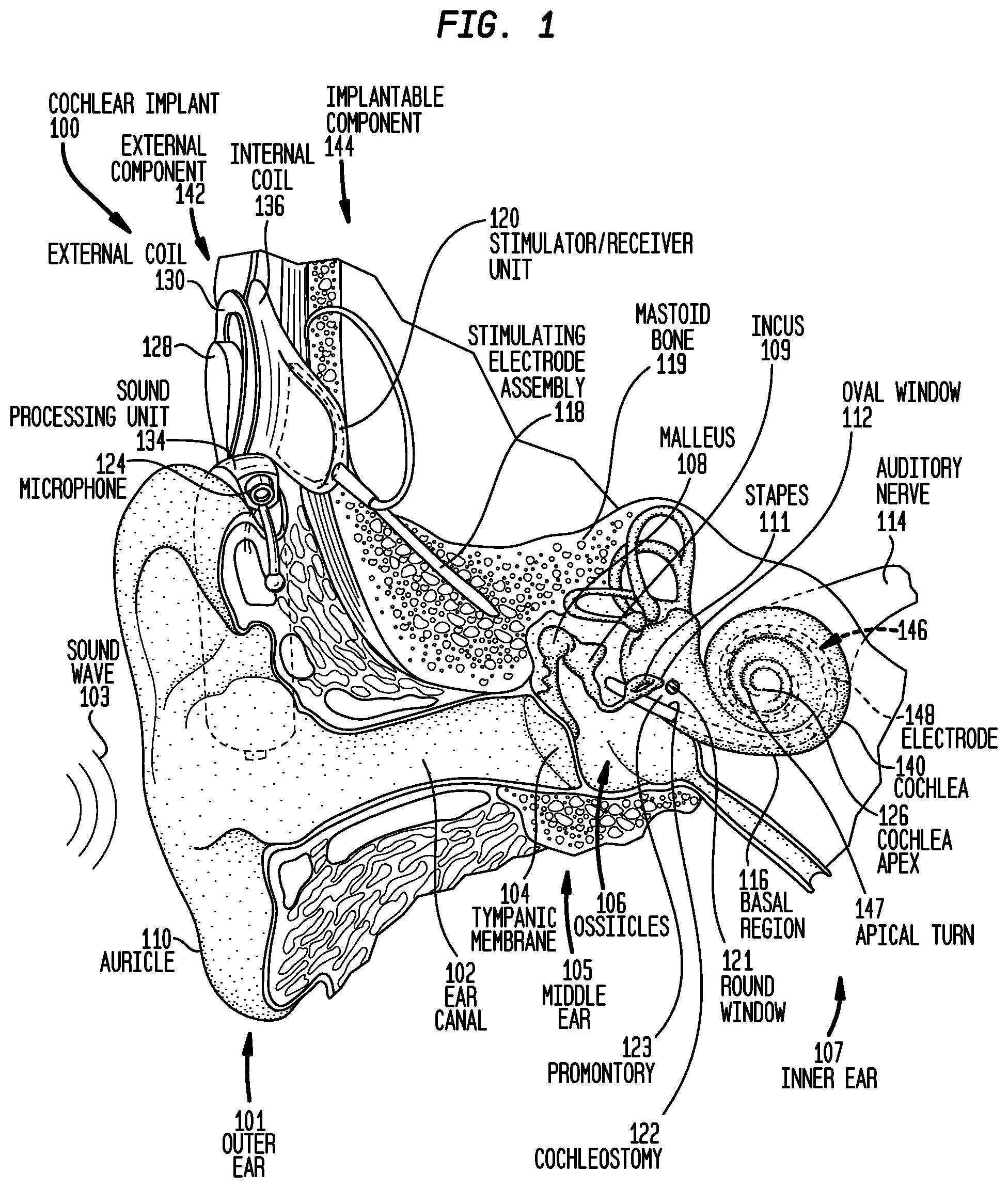 Patent US12318605 Figure 1 – Implantable device migration control