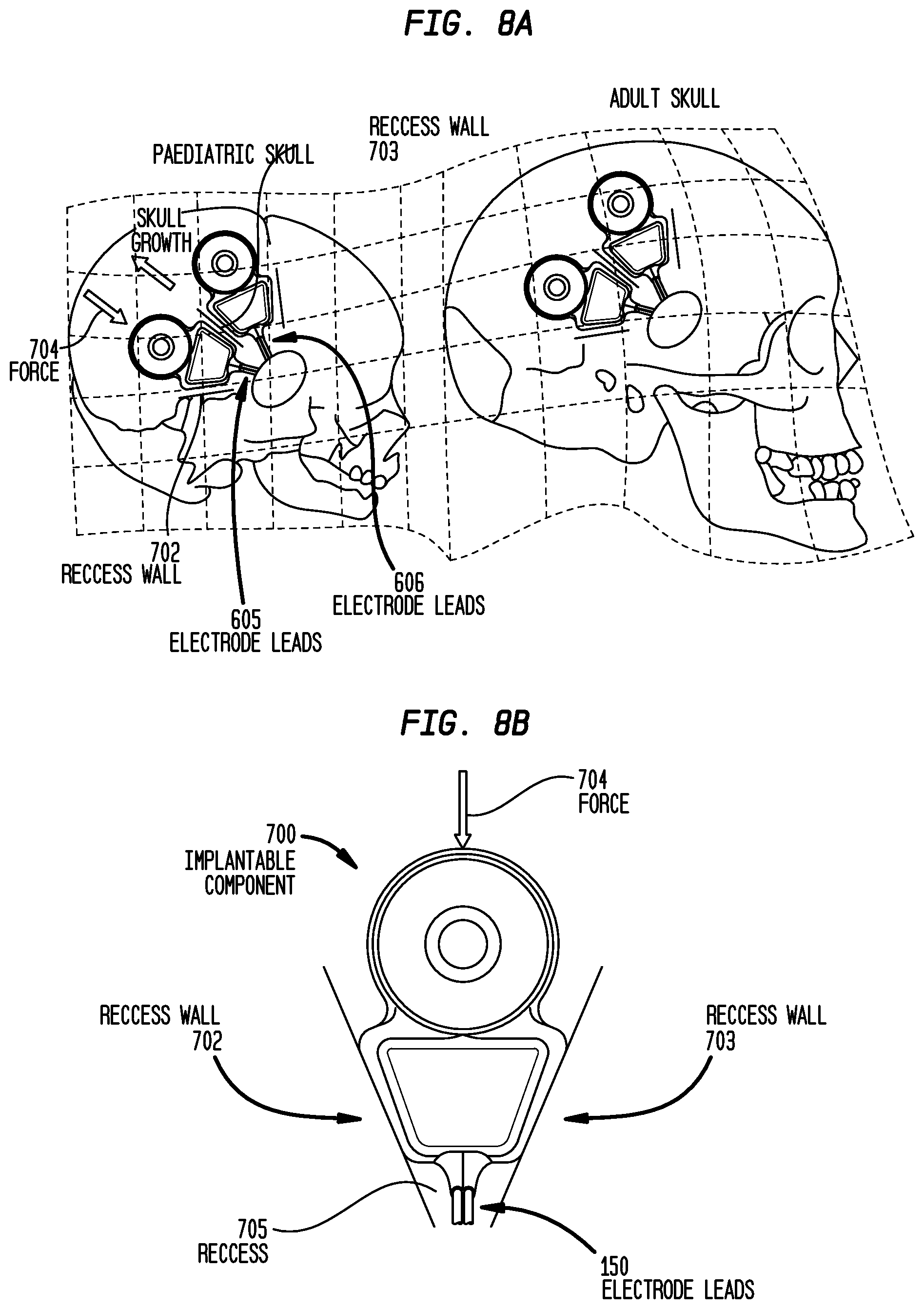 Patent US12318605 Figure 11 – Implantable device migration control